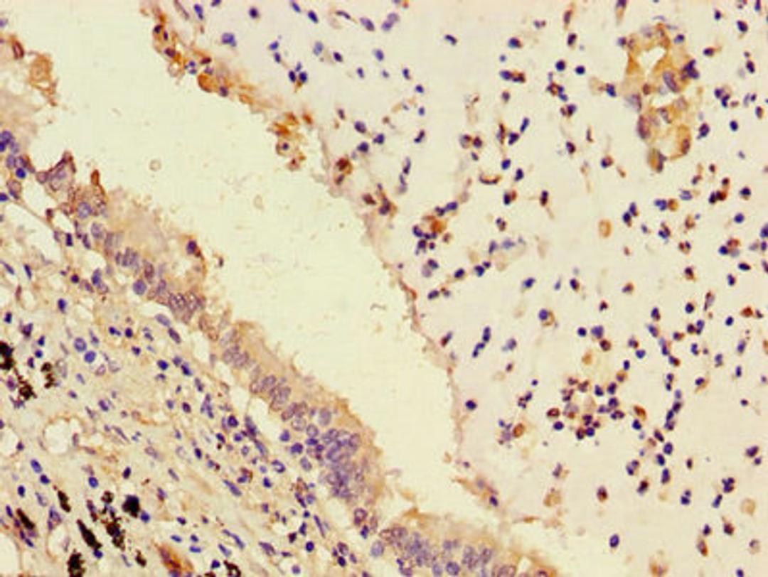 Immunohistochemistry of paraffin-embedded human lung cancer using CSB-PA018415LA01HU at dilution of 1:100