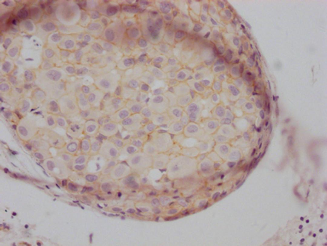 IHC image of CSB-RA155605A0HU diluted at 1:100 and staining in paraffin-embedded human breast cancer performed on a Leica BondTM system. After dewaxing and hydration, antigen retrieval was mediated by high pressure in a citrate buffer (pH 6.0). Section was blocked with 10% normal goat serum 30min at RT. Then primary antibody (1% BSA) was incubated at 4℃ overnight. The primary is detected by a Goat anti-rabbit IgG polymer labeled by HRP and visualized using 0.05% DAB.