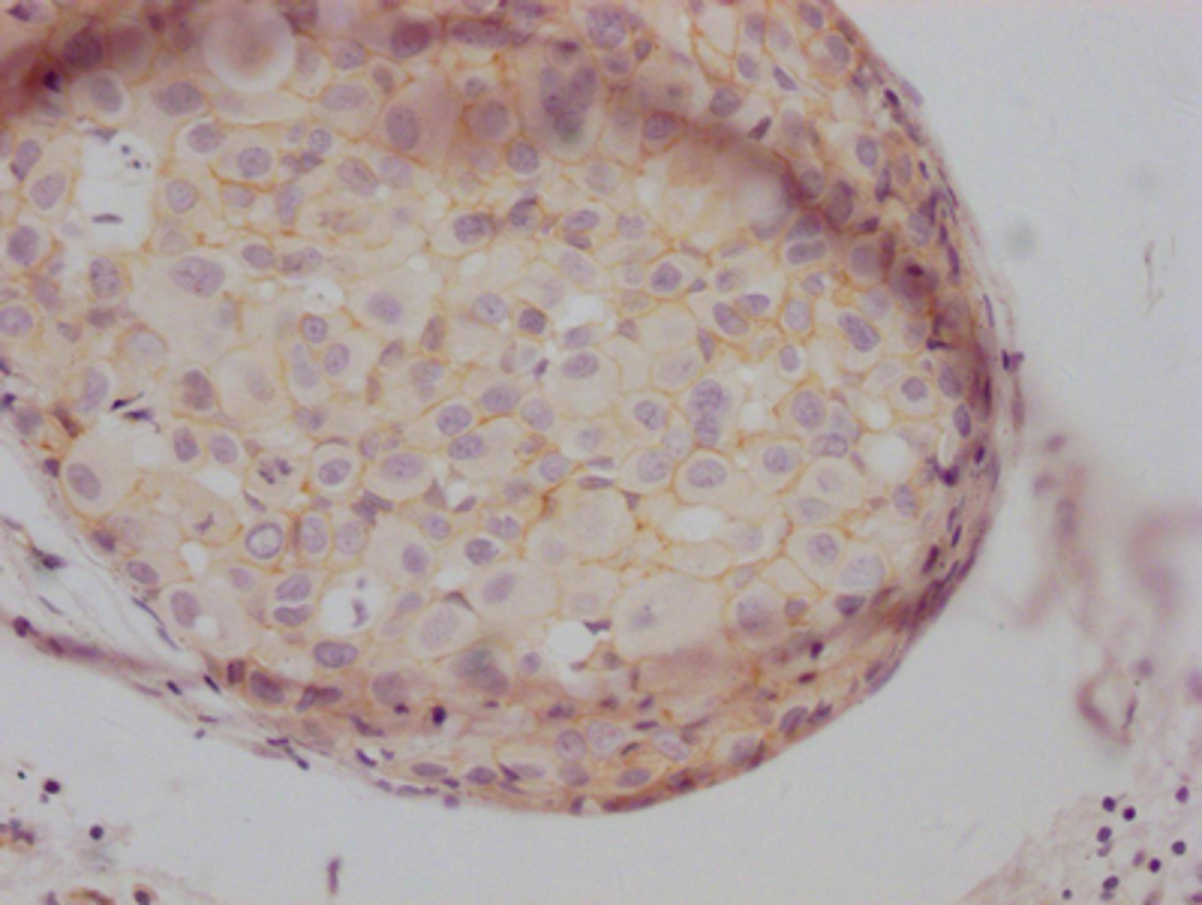 IHC image of CSB-RA155605A0HU diluted at 1:100 and staining in paraffin-embedded human breast cancer performed on a Leica BondTM system. After dewaxing and hydration, antigen retrieval was mediated by high pressure in a citrate buffer (pH 6.0). Section was blocked with 10% normal goat serum 30min at RT. Then primary antibody (1% BSA) was incubated at 4℃ overnight. The primary is detected by a Goat anti-rabbit IgG polymer labeled by HRP and visualized using 0.05% DAB.