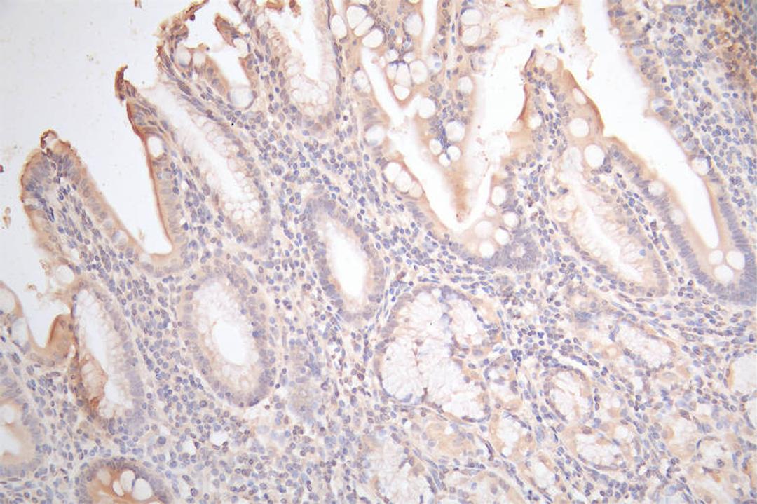 IHC image of CSB-RA009452MA1HU diluted at 1:100 and staining in paraffin-embedded human gastric cancer performed on a Leica BondTM system. After dewaxing and hydration,  antigen retrieval was mediated by high pressure in a citrate buffer (pH 6.0). Section was blocked with 10% normal goat serum 30min at RT. Then primary antibody (1% BSA) was incubated at 4°C overnight. The primary is detected by a Goat anti-Mouse IgG labeled by HRP and visualized using 0.05% DAB.