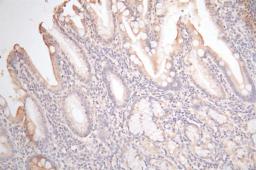 IHC image of CSB-RA009452MA1HU diluted at 1:100 and staining in paraffin-embedded human gastric cancer performed on a Leica BondTM system. After dewaxing and hydration,  antigen retrieval was mediated by high pressure in a citrate buffer (pH 6.0). Section was blocked with 10% normal goat serum 30min at RT. Then primary antibody (1% BSA) was incubated at 4°C overnight. The primary is detected by a Goat anti-Mouse IgG labeled by HRP and visualized using 0.05% DAB.