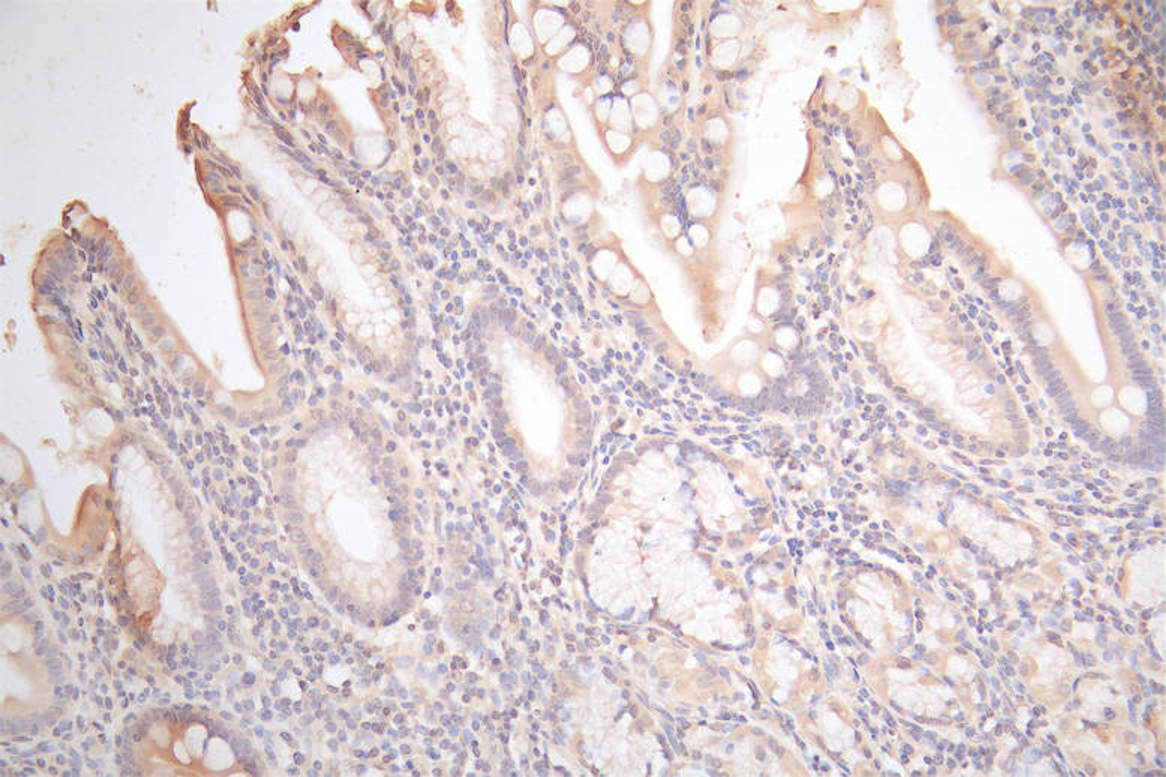 IHC image of CSB-RA009452MA1HU diluted at 1:100 and staining in paraffin-embedded human gastric cancer performed on a Leica BondTM system. After dewaxing and hydration,  antigen retrieval was mediated by high pressure in a citrate buffer (pH 6.0). Section was blocked with 10% normal goat serum 30min at RT. Then primary antibody (1% BSA) was incubated at 4°C overnight. The primary is detected by a Goat anti-Mouse IgG labeled by HRP and visualized using 0.05% DAB.