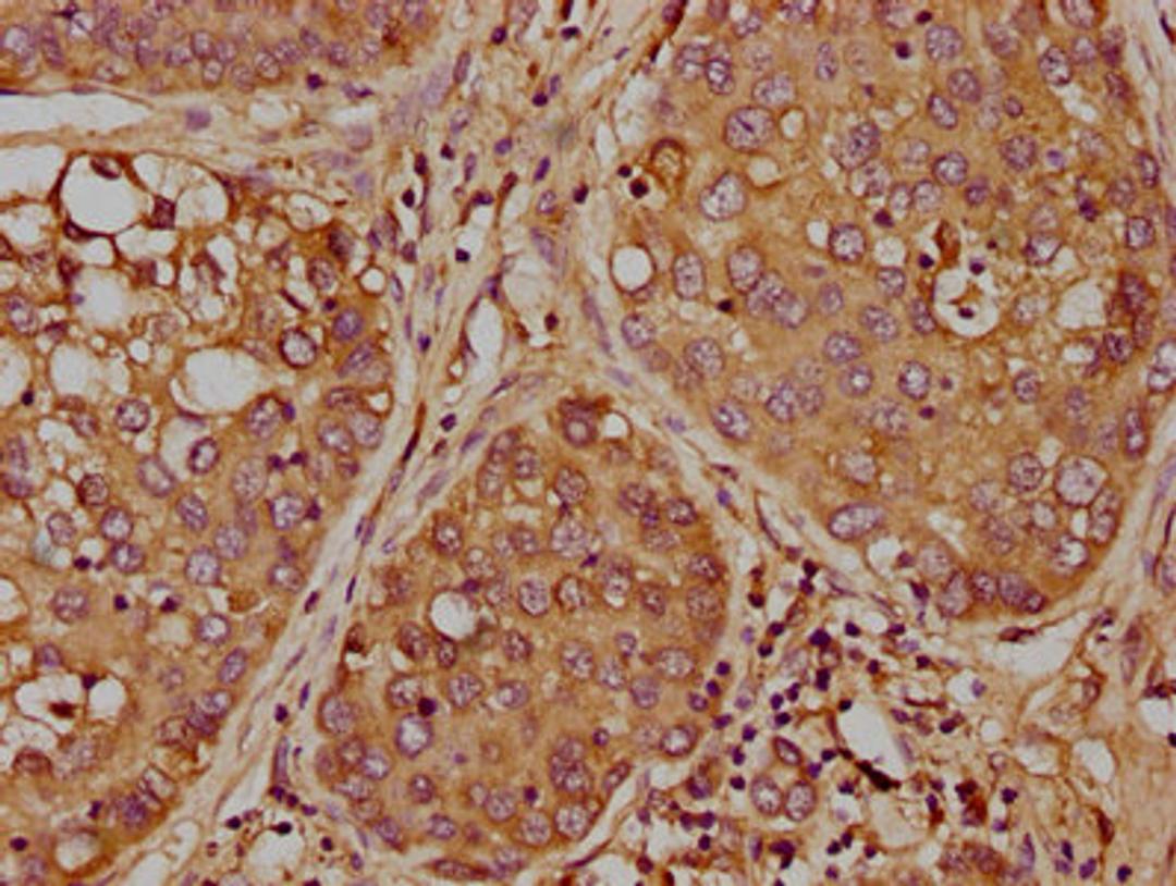 IHC image of CSB-PA857448LA01HU diluted at 1:300 and staining in paraffin-embedded human liver cancer performed on a Leica BondTM system. After dewaxing and hydration, antigen retrieval was mediated by high pressure in a citrate buffer (pH 6.0). Section was blocked with 10% normal goat serum 30min at RT. Then primary antibody (1% BSA) was incubated at 4°C overnight. The primary is detected by a biotinylated secondary antibody and visualized using an HRP conjugated SP system.