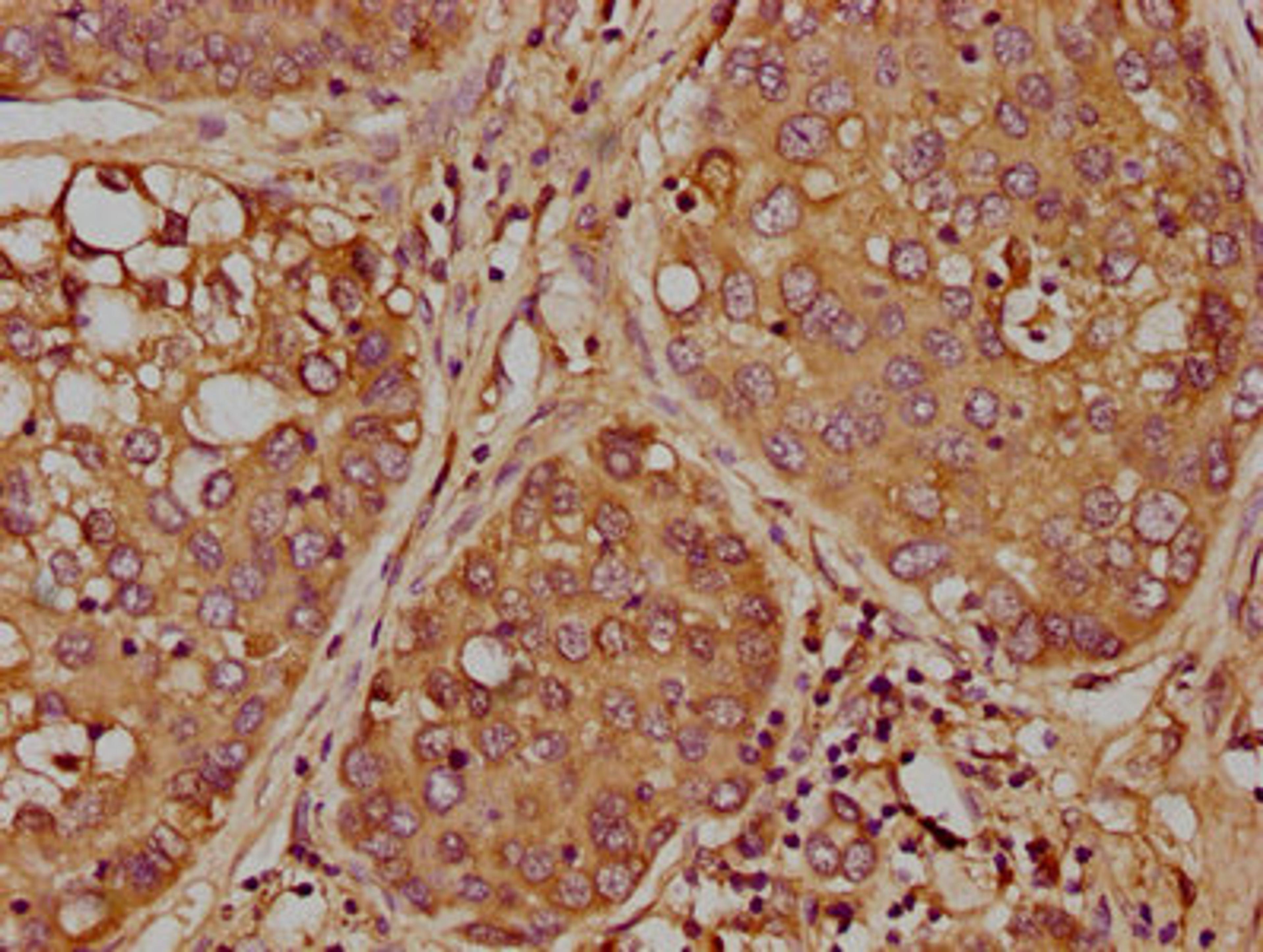 IHC image of CSB-PA857448LA01HU diluted at 1:300 and staining in paraffin-embedded human liver cancer performed on a Leica BondTM system. After dewaxing and hydration, antigen retrieval was mediated by high pressure in a citrate buffer (pH 6.0). Section was blocked with 10% normal goat serum 30min at RT. Then primary antibody (1% BSA) was incubated at 4°C overnight. The primary is detected by a biotinylated secondary antibody and visualized using an HRP conjugated SP system.