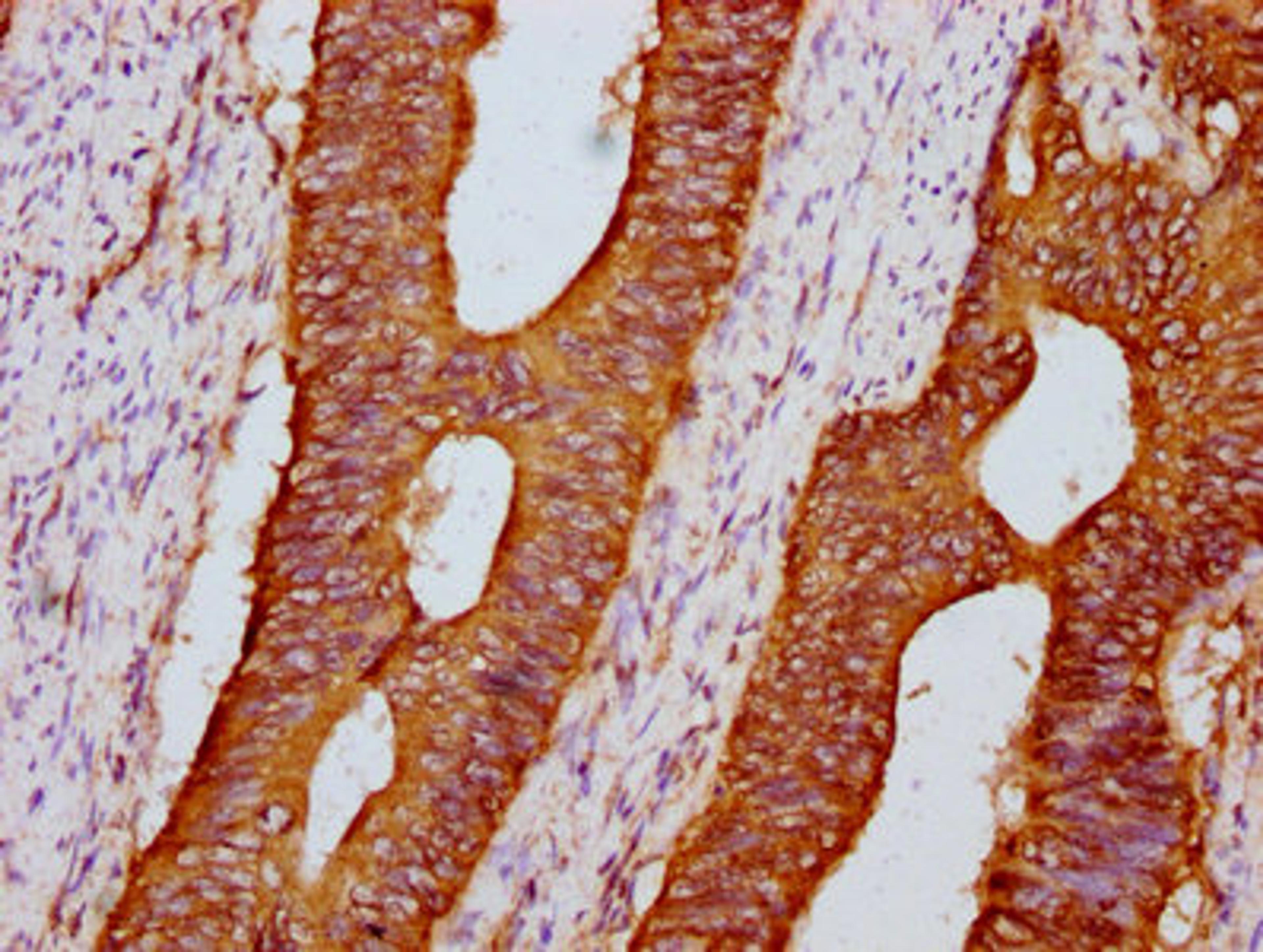 IHC image of CSB-PA23149A0Rb diluted at 1:600 and staining in paraffin-embedded human colon cancer performed on a Leica BondTM system. After dewaxing and hydration, antigen retrieval was mediated by high pressure in a citrate buffer (pH 6.0). Section was blocked with 10% normal goat serum 30min at RT. Then primary antibody (1% BSA) was incubated at 4&deg;C overnight. The primary is detected by a biotinylated secondary antibody and visualized using an HRP conjugated SP system.