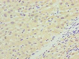 Immunohistochemistry of paraffin-embedded human liver cancer using CSB-PA818240LA01HU at dilution of 1:100