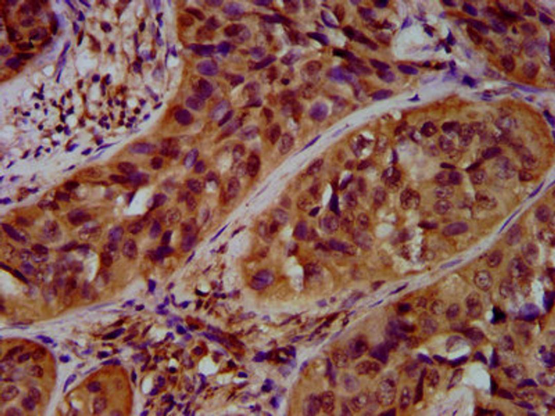 IHC image of CSB-PA681513LA01HU diluted at 1:600 and staining in paraffin-embedded human cervical cancer performed on a Leica BondTM system. After dewaxing and hydration, antigen retrieval was mediated by high pressure in a citrate buffer (pH 6.0). Section was blocked with 10% normal goat serum 30min at RT. Then primary antibody (1% BSA) was incubated at 4&deg;C overnight. The primary is detected by a biotinylated secondary antibody and visualized using an HRP conjugated SP system.