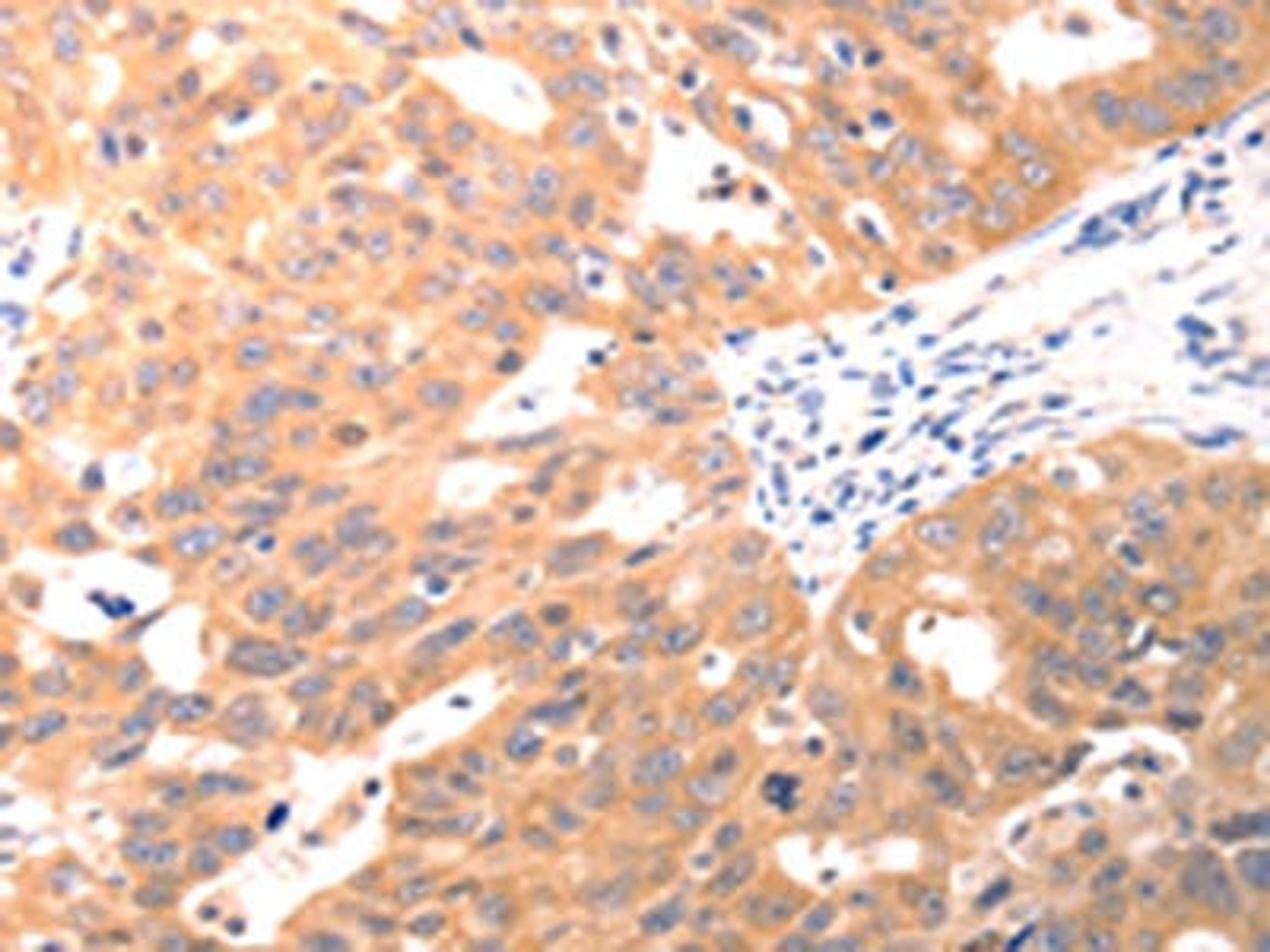 The image on the left is immunohistochemistry of paraffin-embedded Human ovarian cancer tissue using CSB-PA796509(CAPNS1 Antibody) at dilution 1/60, on the right is treated with fusion protein. (Original magnification: ×200)