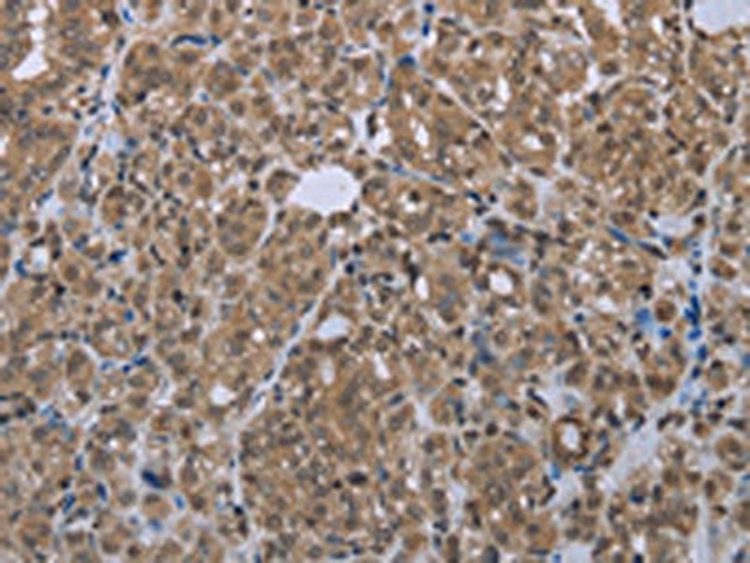 The image is immunohistochemistry of paraffin-embedded Human thyroid cancer tissue using CSB-PA780020(SMAD4 Antibody) at dilution 1/20. (Original magnification: ×200)