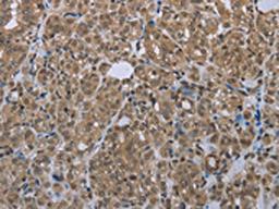 The image is immunohistochemistry of paraffin-embedded Human thyroid cancer tissue using CSB-PA780020(SMAD4 Antibody) at dilution 1/20. (Original magnification: ×200)