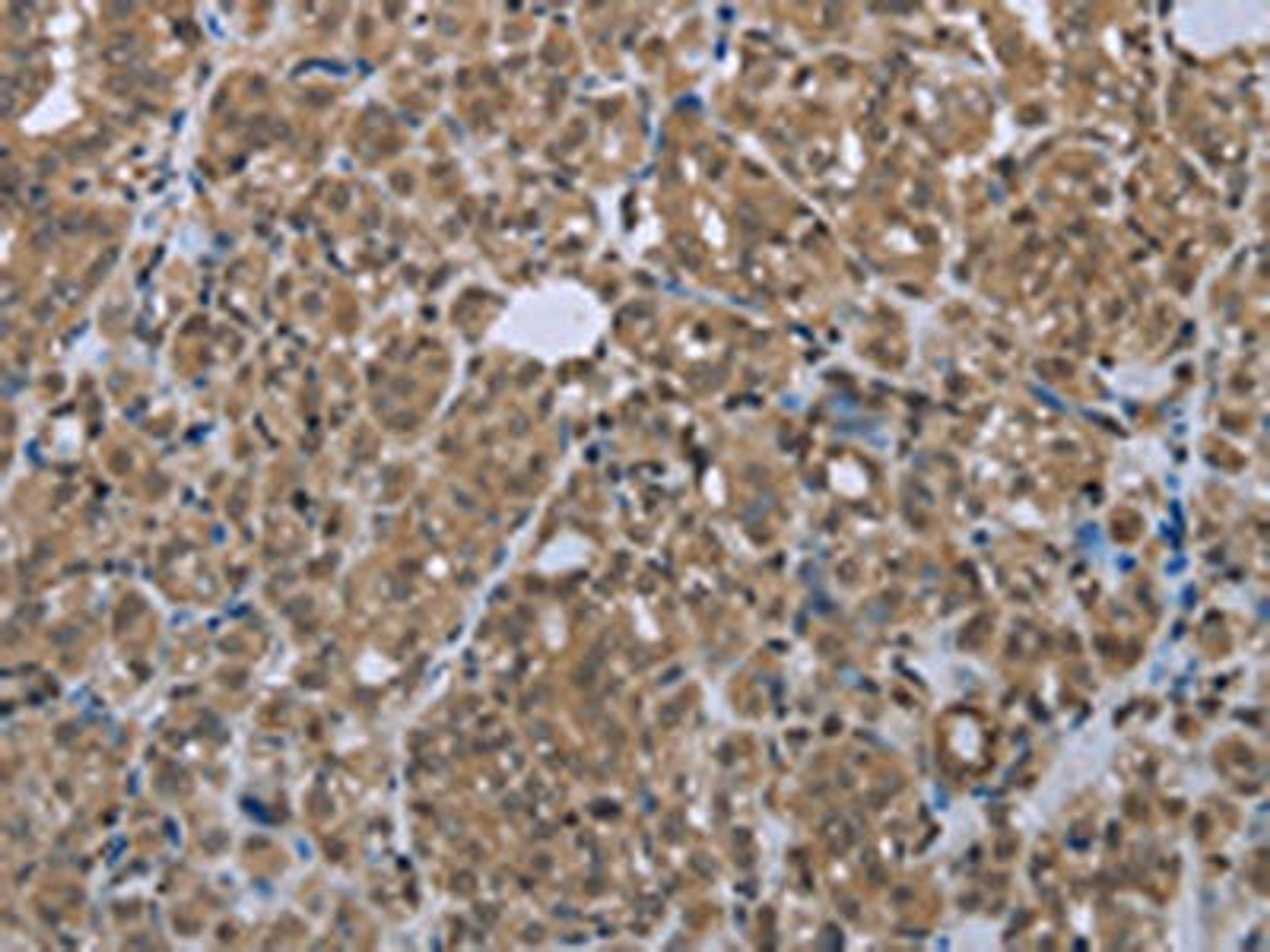 The image is immunohistochemistry of paraffin-embedded Human thyroid cancer tissue using CSB-PA780020(SMAD4 Antibody) at dilution 1/20. (Original magnification: ×200)