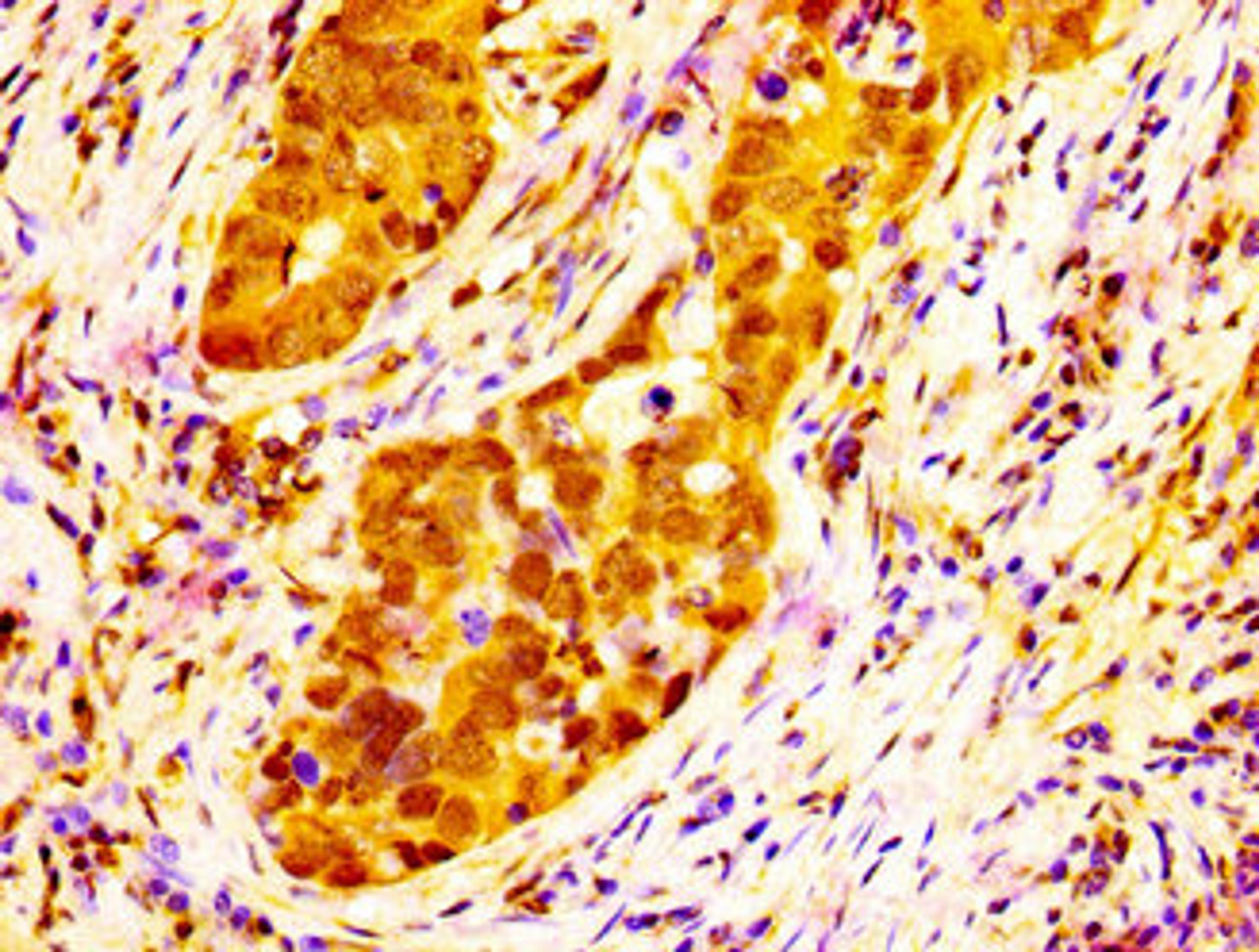 IHC image of CSB-PA863939LA01HU diluted at 1:300 and staining in paraffin-embedded human pancreatic cancer performed on a Leica BondTM system. After dewaxing and hydration, antigen retrieval was mediated by high pressure in a citrate buffer (pH 6.0). Section was blocked with 10% normal goat serum 30min at RT. Then primary antibody (1% BSA) was incubated at 4°C overnight. The primary is detected by a biotinylated secondary antibody and visualized using an HRP conjugated SP system.