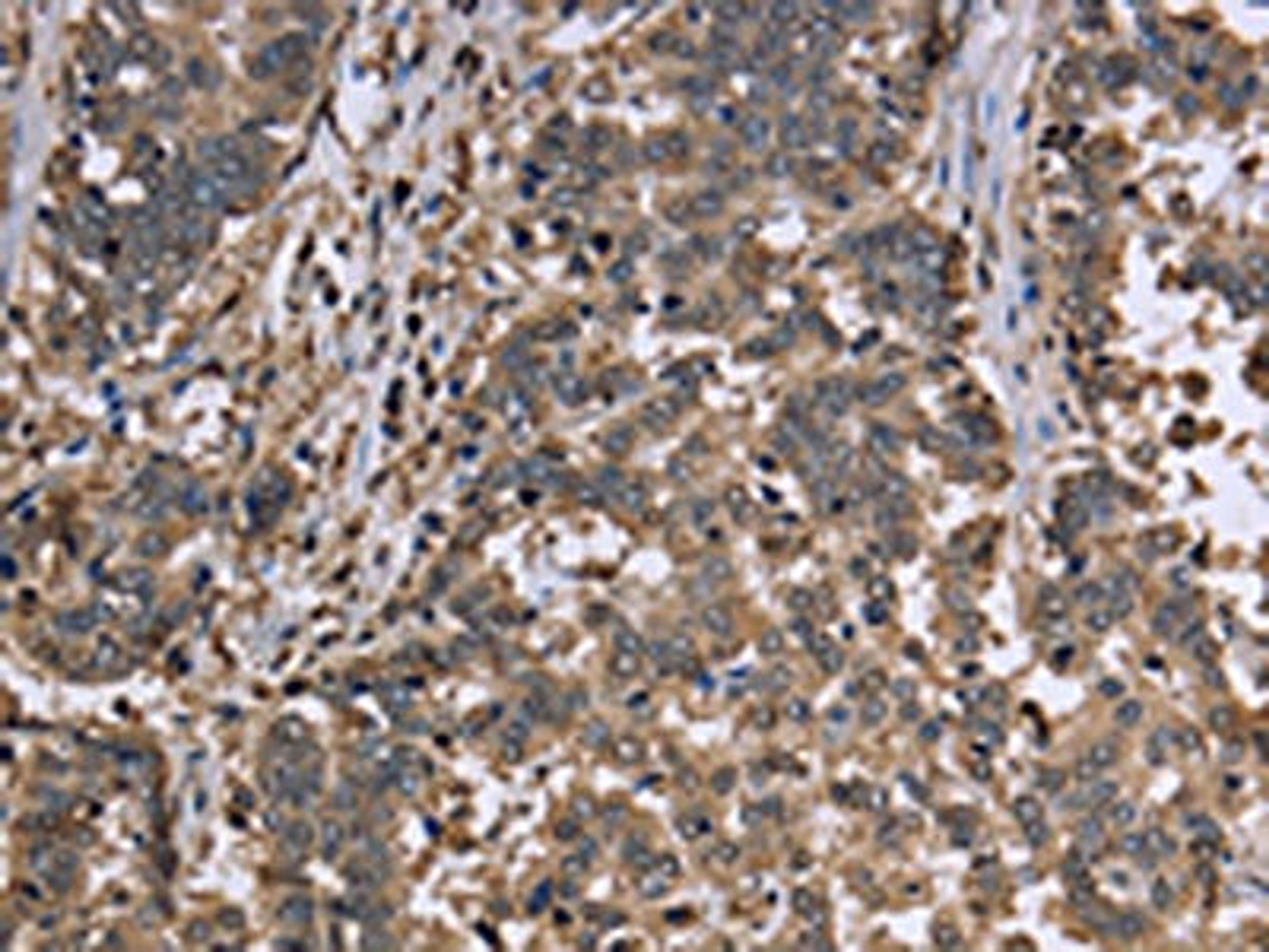The image is immunohistochemistry of paraffin-embedded Human liver cancer tissue using CSB-PA779821(GAPDH Antibody) at dilution 1/30. (Original magnification: ×200)