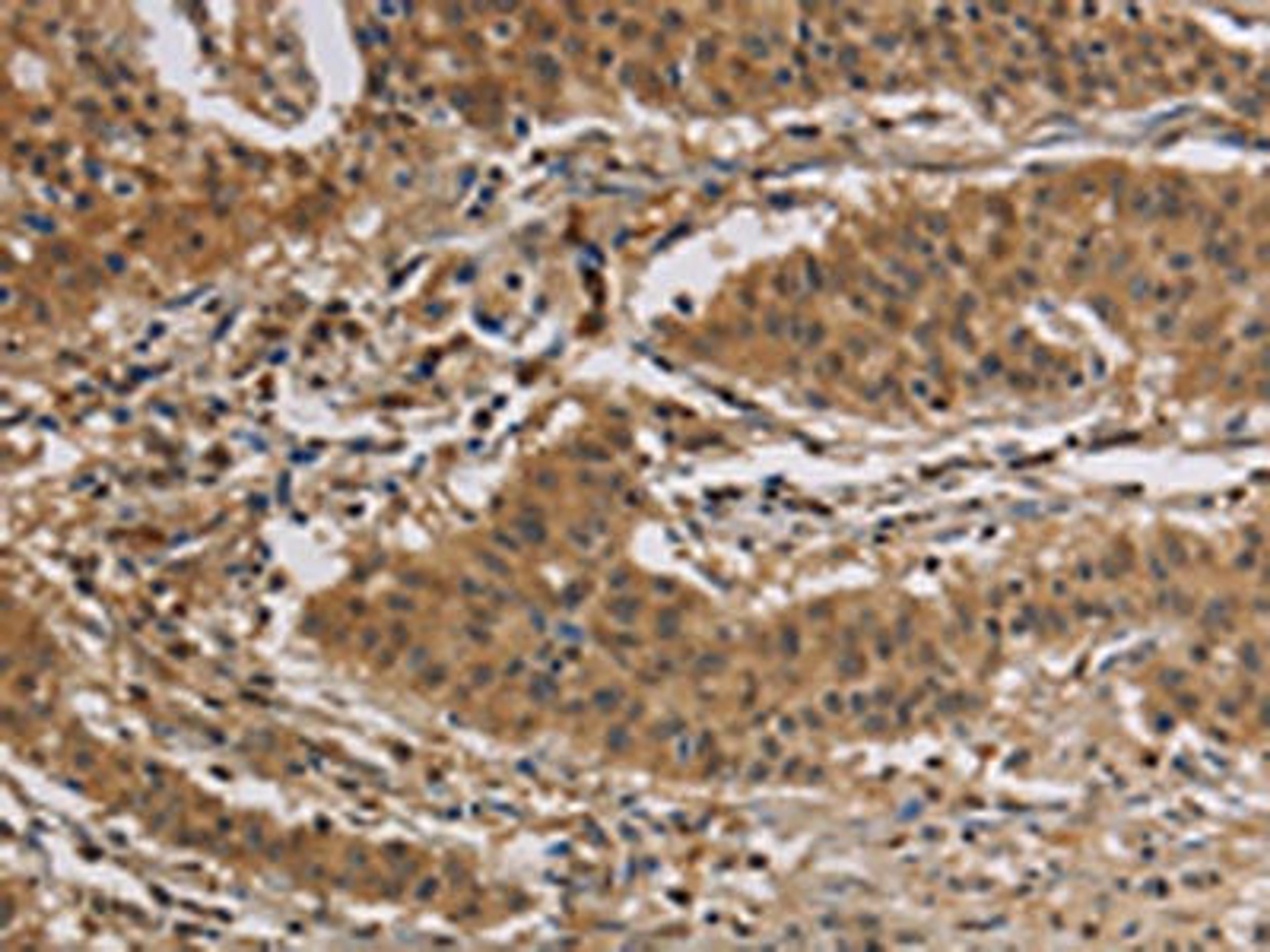 The image is immunohistochemistry of paraffin-embedded Human gastric cancer tissue using CSB-PA984107(CASP3 Antibody) at dilution 1/30. (Original magnification: ×200)