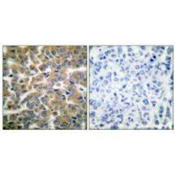 Immunohistochemical analysis of paraffin-embedded human breast carcinoma tissue using GR (Ab-211) antibody.