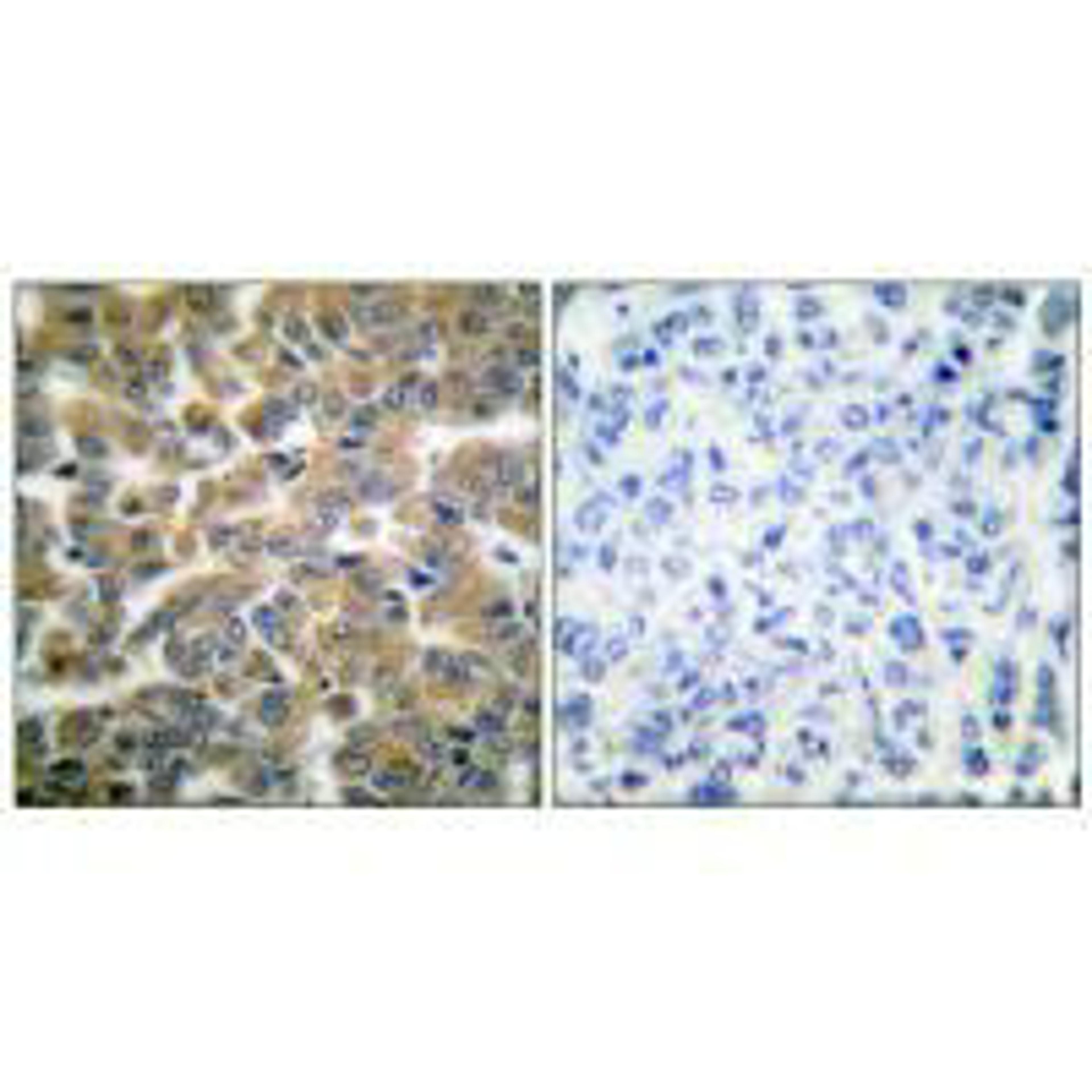 Immunohistochemical analysis of paraffin-embedded human breast carcinoma tissue using GR (Ab-211) antibody.