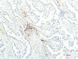 Immunohistochemical analysis of paraffin-embedded Human Lung Carcinoma Tissue using JAK1 Mouse mAb diluted at 1:200.