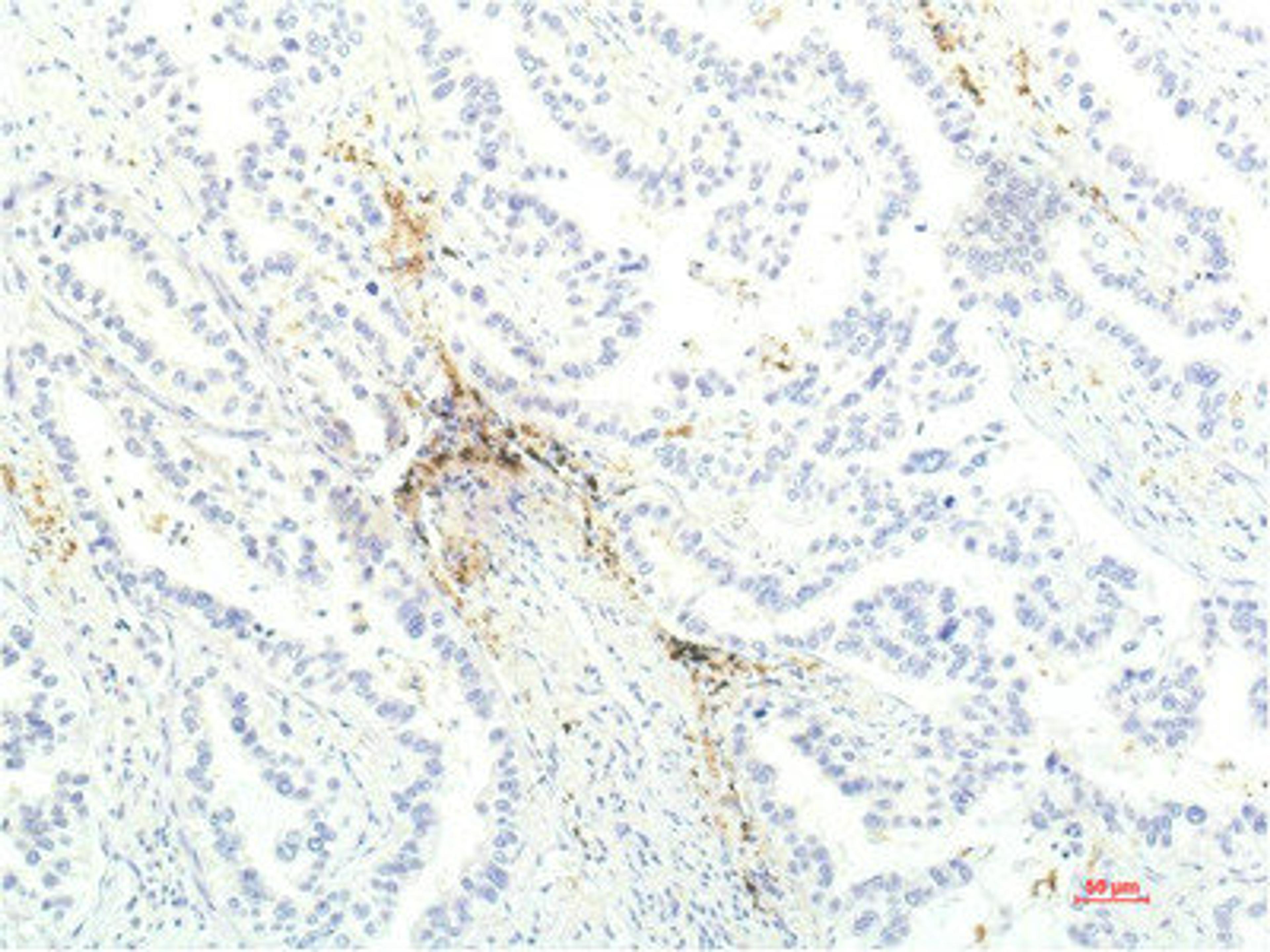 Immunohistochemical analysis of paraffin-embedded Human Lung Carcinoma Tissue using JAK1 Mouse mAb diluted at 1:200.