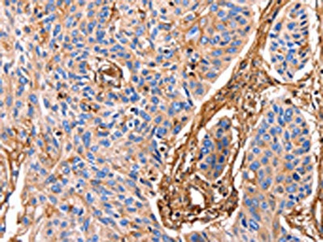 The image on the left is immunohistochemistry of paraffin-embedded Human esophagus cancer tissue using CSB-PA217773(ANXA6 Antibody) at dilution 1/17, on the right is treated with fusion protein. (Original magnification: ×200)