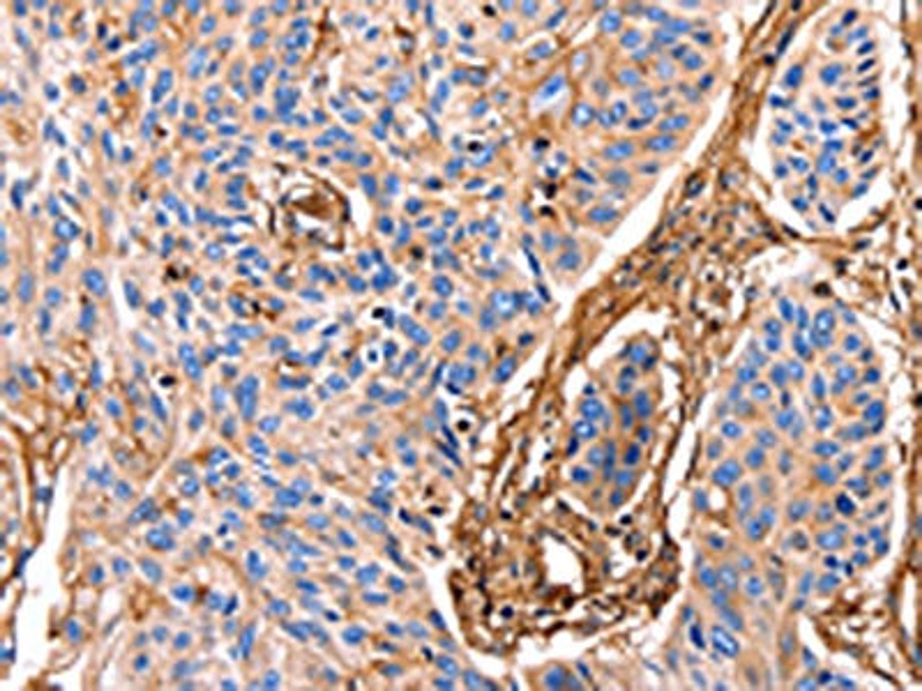 The image on the left is immunohistochemistry of paraffin-embedded Human esophagus cancer tissue using CSB-PA217773(ANXA6 Antibody) at dilution 1/17, on the right is treated with fusion protein. (Original magnification: ×200)