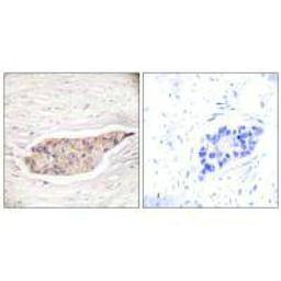Immunohistochemical analysis of paraffin-embedded human breast carcinoma tissue using Annexin A6 antibody.