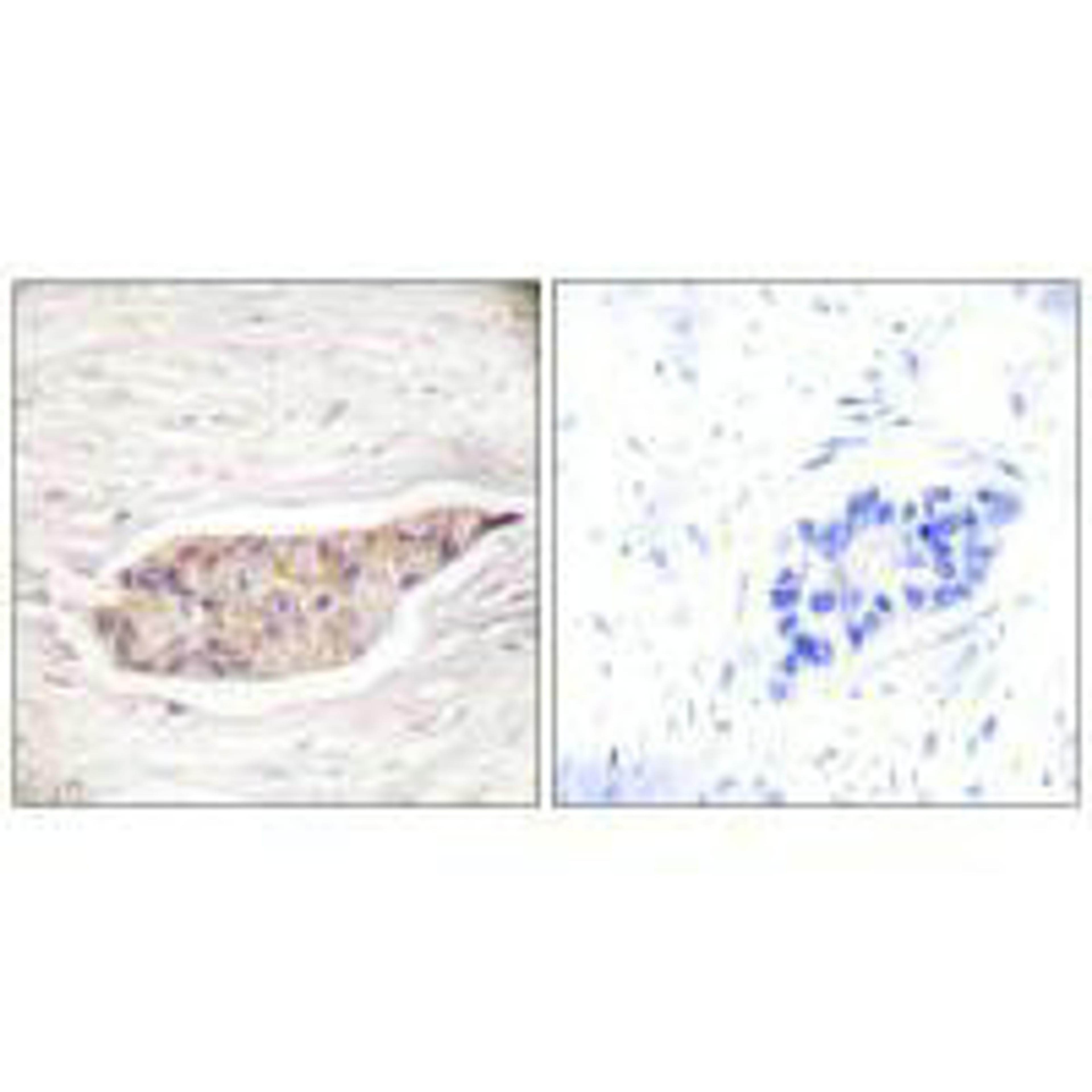 Immunohistochemical analysis of paraffin-embedded human breast carcinoma tissue using Annexin A6 antibody.