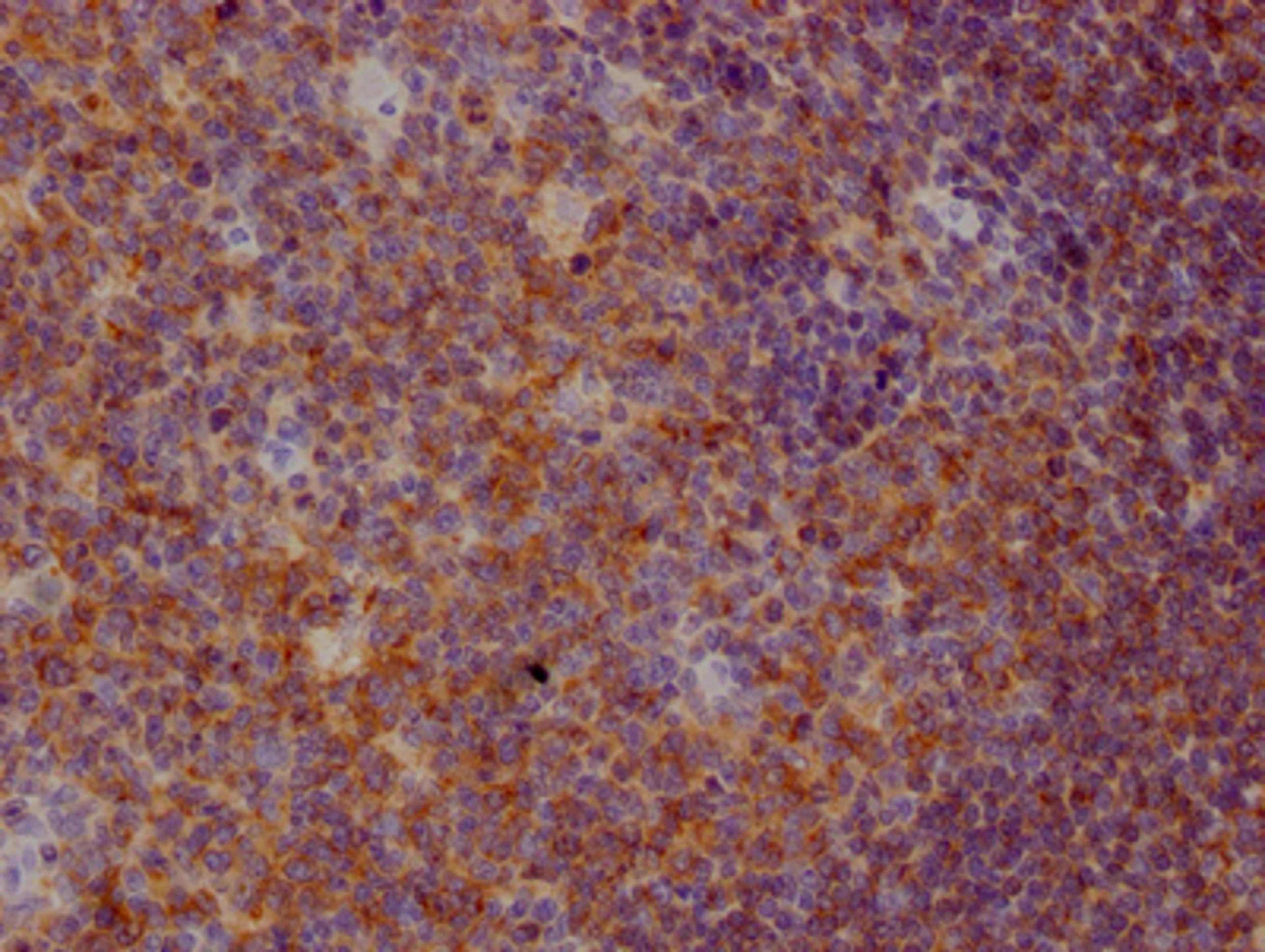 IHC image of CSB-RA962691A0HU diluted at 1:100 and staining in paraffin-embedded human tonsil tissue performed on a Leica BondTM system. After dewaxing and hydration, antigen retrieval was mediated by high pressure in a citrate buffer (pH 6.0). Section was blocked with 10% normal goat serum 30min at RT. Then primary antibody (1% BSA) was incubated at 4℃ overnight. The primary is detected by a Goat anti-rabbit IgG polymer labeled by HRP and visualized using 0.05% DAB.