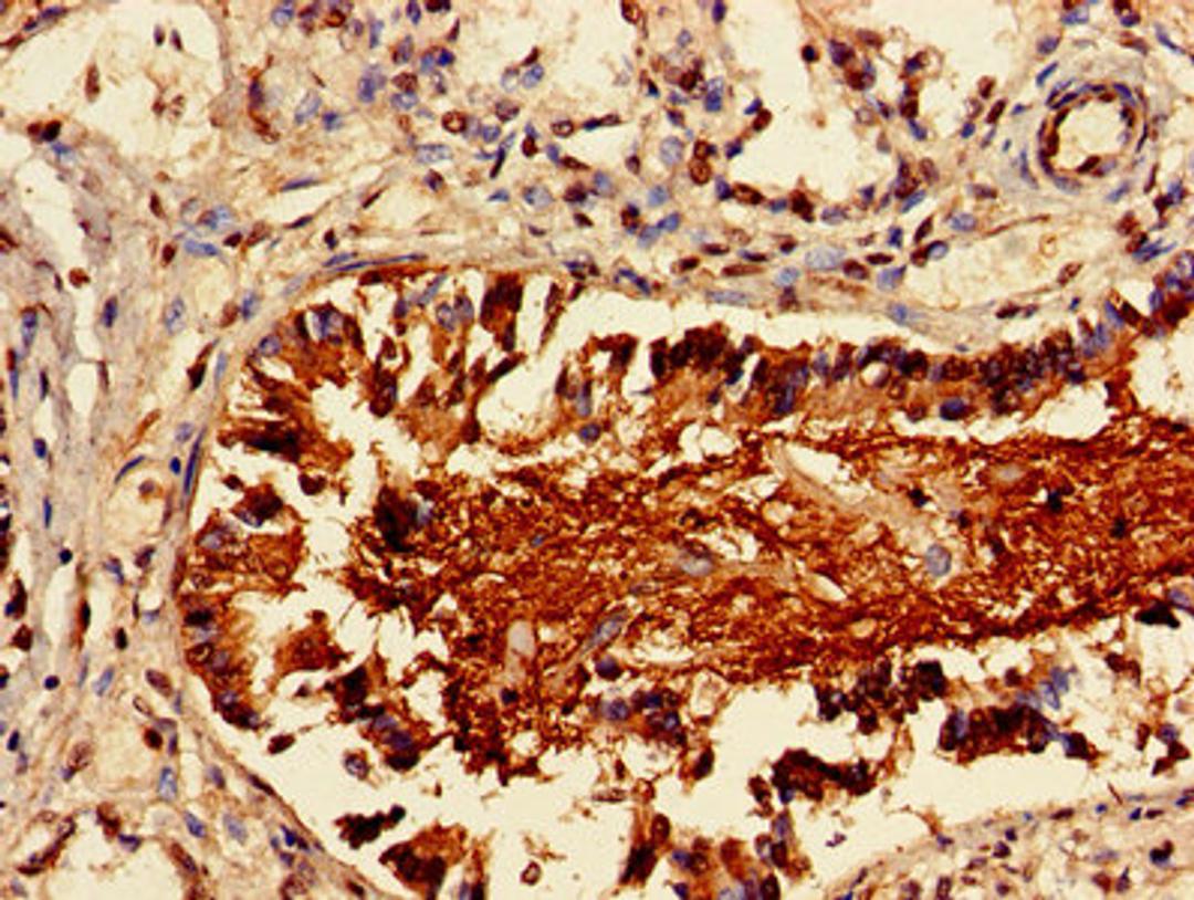 Immunohistochemistry of paraffin-embedded human lung cancer using CSB-PA012721LA01HU at dilution of 1:100