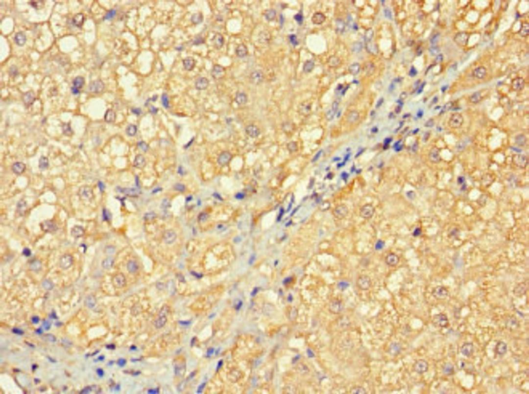 Immunohistochemistry of paraffin-embedded human liver cancer using CSB-PA732584LA01HU at dilution of 1:100