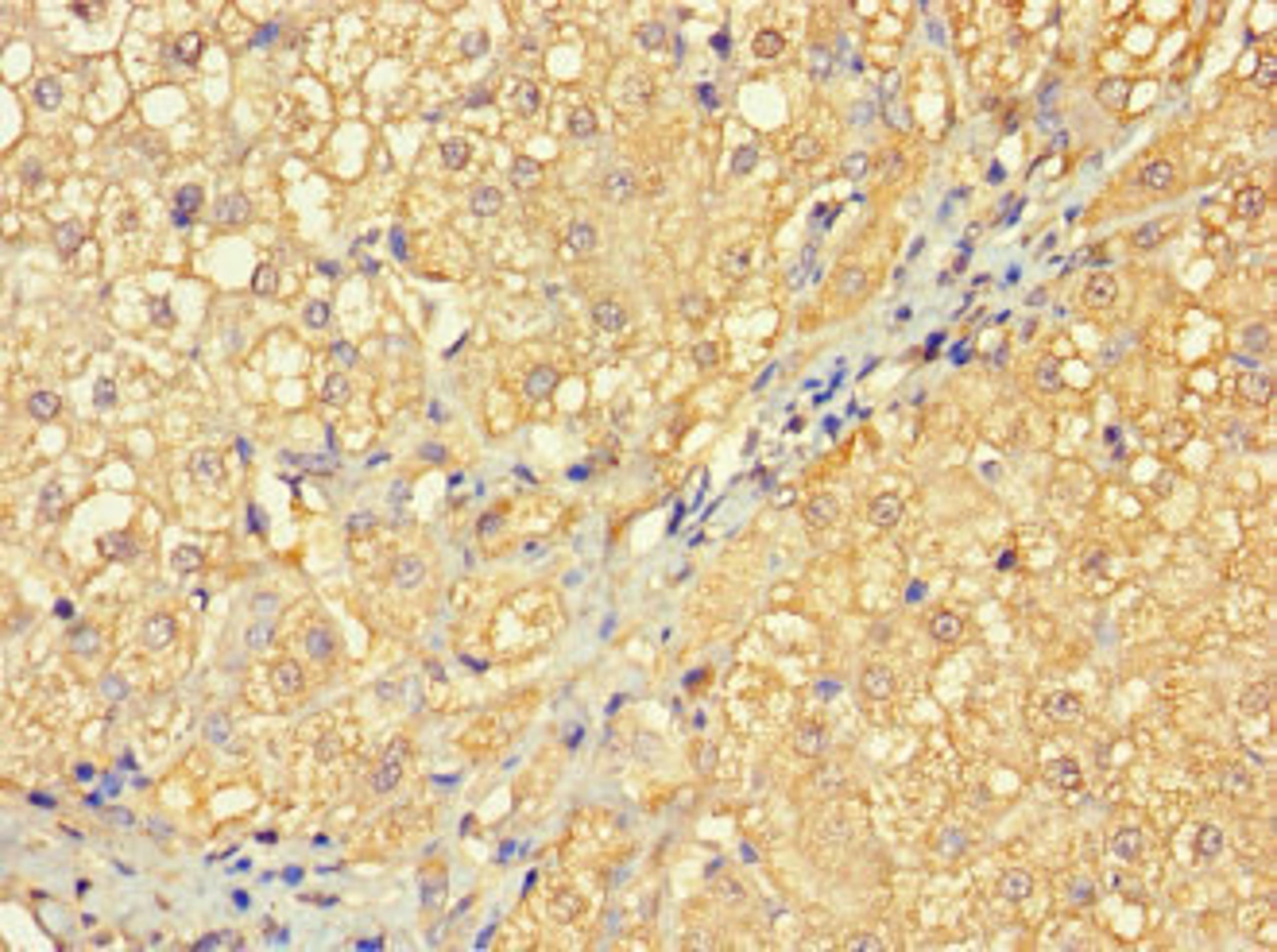 Immunohistochemistry of paraffin-embedded human liver cancer using CSB-PA732584LA01HU at dilution of 1:100