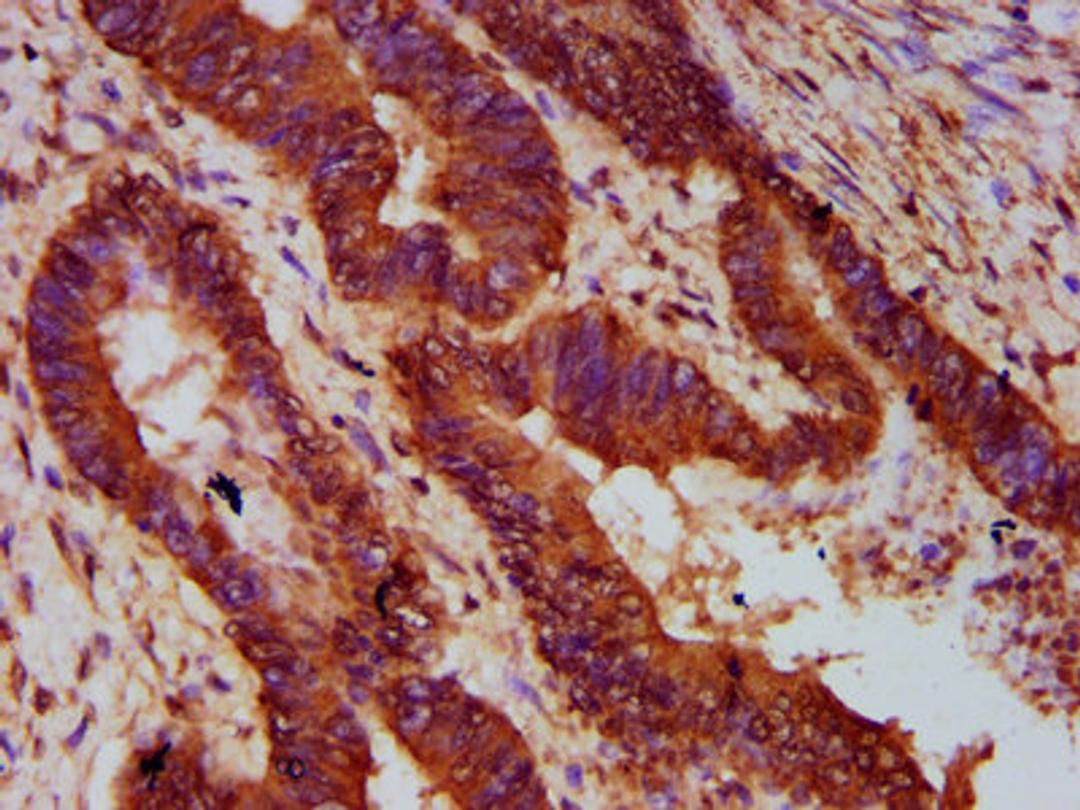 IHC image of CSB-PA836275LA01HU diluted at 1:300 and staining in paraffin-embedded human colon cancer performed on a Leica BondTM system. After dewaxing and hydration, antigen retrieval was mediated by high pressure in a citrate buffer (pH 6.0). Section was blocked with 10% normal goat serum 30min at RT. Then primary antibody (1% BSA) was incubated at 4&deg;C overnight. The primary is detected by a biotinylated secondary antibody and visualized using an HRP conjugated SP system.