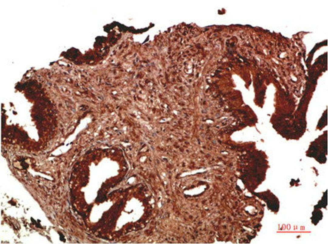 Immunohistochemical analysis of paraffin-embedded Human Prostate Carcinoma Tissue using ATM Rabbit pAb diluted at 1:200.