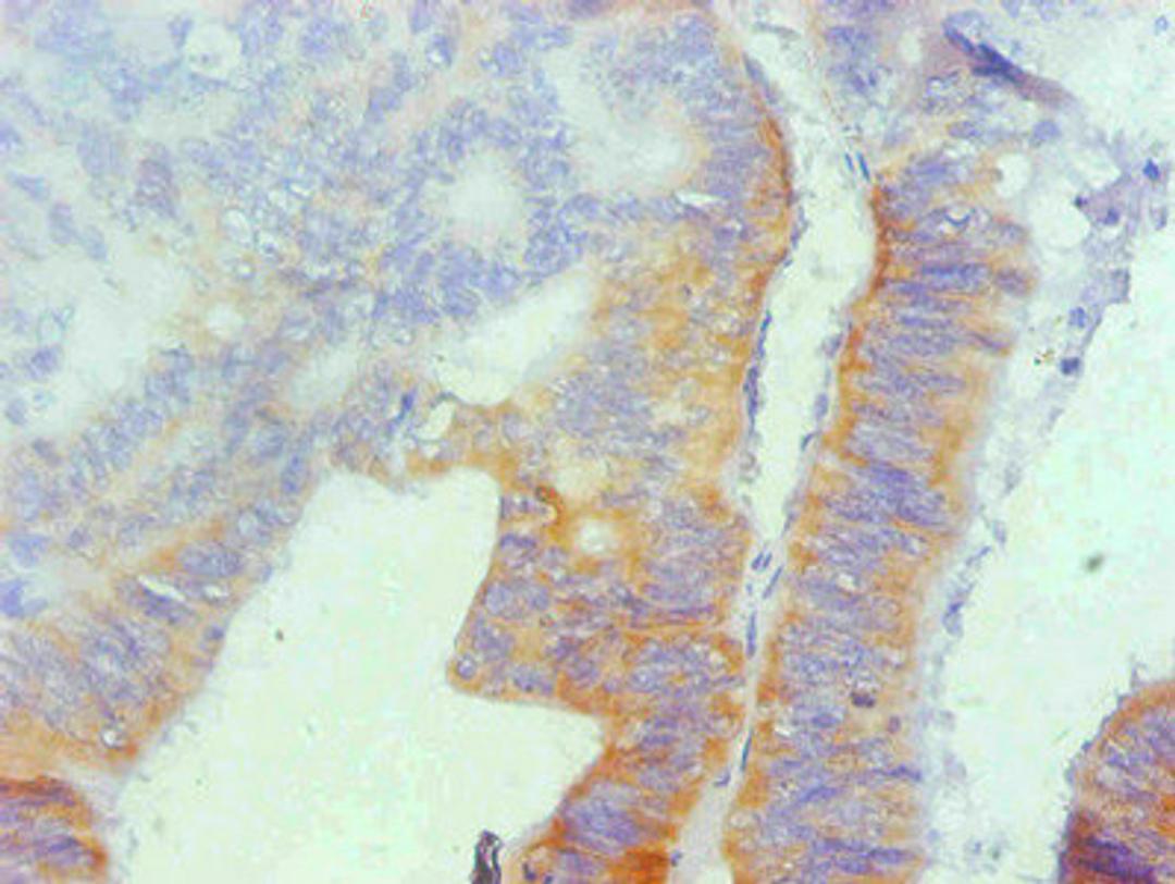 Immunohistochemical of paraffin-embedded human colon cancer using CSB-MA069021A0m at dilution of 1:200
