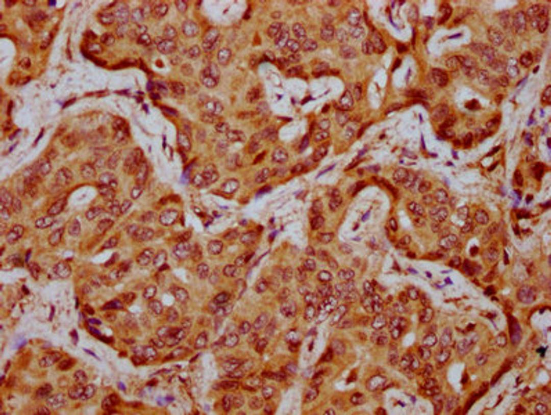 IHC image of CSB-PA025865LA01HU diluted at 1:300 and staining in paraffin-embedded human liver cancer performed on a Leica BondTM system. After dewaxing and hydration, antigen retrieval was mediated by high pressure in a citrate buffer (pH 6.0). Section was blocked with 10% normal goat serum 30min at RT. Then primary antibody (1% BSA) was incubated at 4&deg;C overnight. The primary is detected by a biotinylated secondary antibody and visualized using an HRP conjugated SP system.