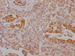 IHC image of CSB-RA787345A0HU diluted at 1:100 and staining in paraffin-embedded human pancreatic tissue performed on a Leica BondTM system. After dewaxing and hydration, antigen retrieval was mediated by high pressure in a citrate buffer (pH 6.0). Section was blocked with 10% normal goat serum 30min at RT. Then primary antibody (1% BSA) was incubated at 4℃ overnight. The primary is detected by a Goat anti-rabbit IgG polymer labeled by HRP and visualized using 0.05% DAB.