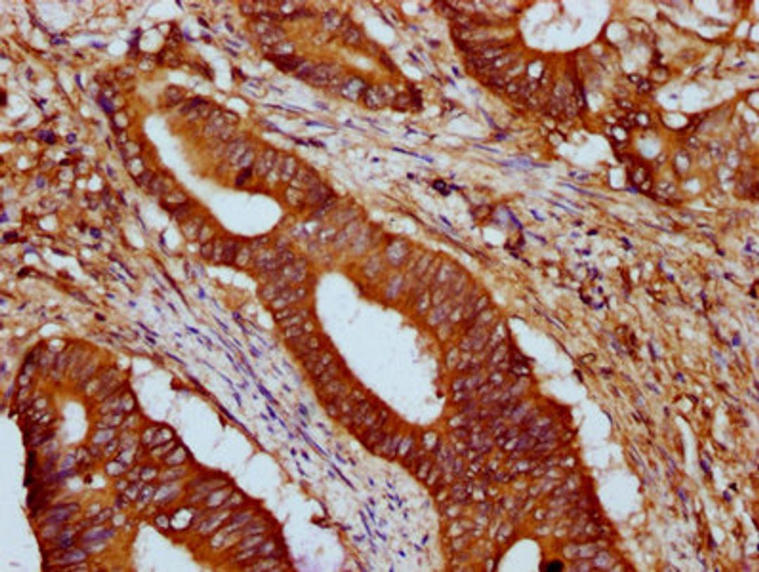 IHC image of CSB-PA010216LA01HU diluted at 1:500 and staining in paraffin-embedded human colon cancer performed on a Leica BondTM system. After dewaxing and hydration, antigen retrieval was mediated by high pressure in a citrate buffer (pH 6.0). Section was blocked with 10% normal goat serum 30min at RT. Then primary antibody (1% BSA) was incubated at 4&deg;C overnight. The primary is detected by a biotinylated secondary antibody and visualized using an HRP conjugated SP system.