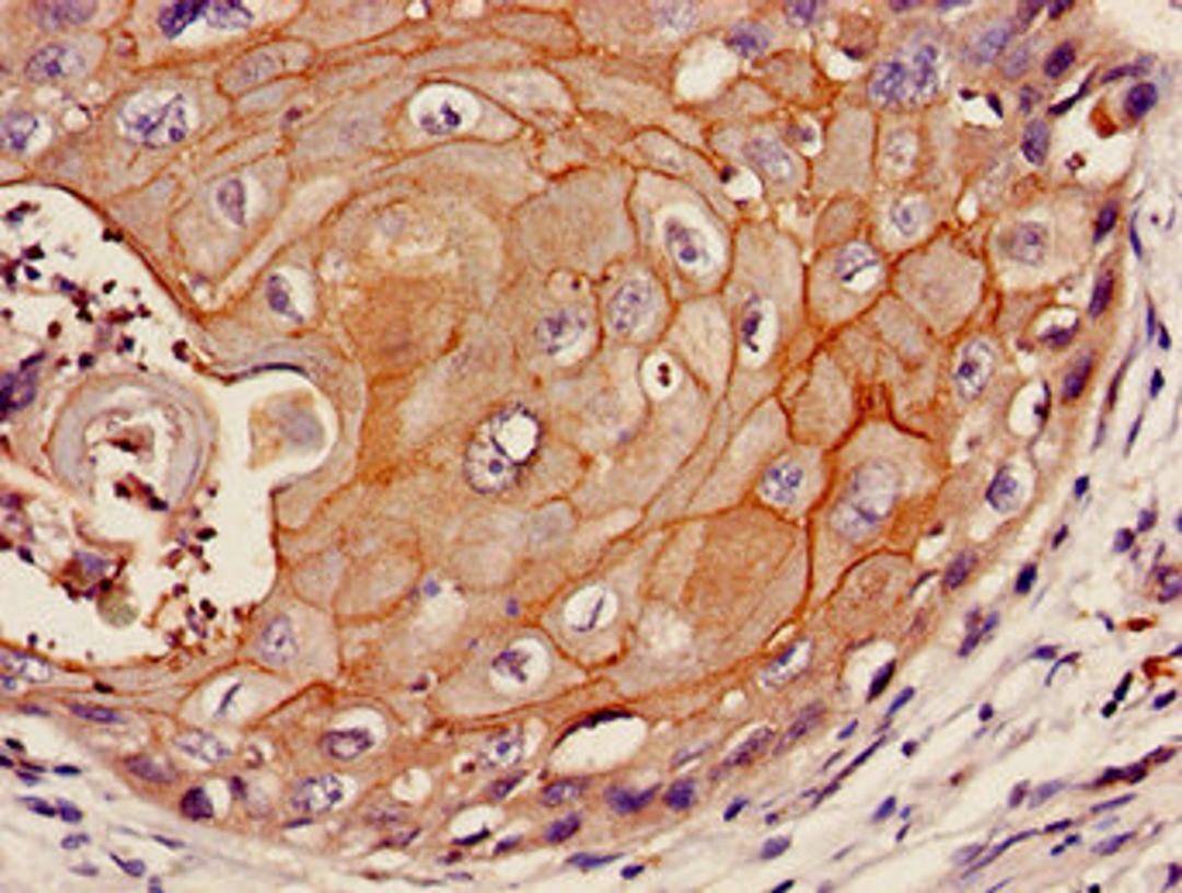 Immunohistochemistry of paraffin-embedded human cervical cancer using CSB-PA897579LA01HU at dilution of 1:100