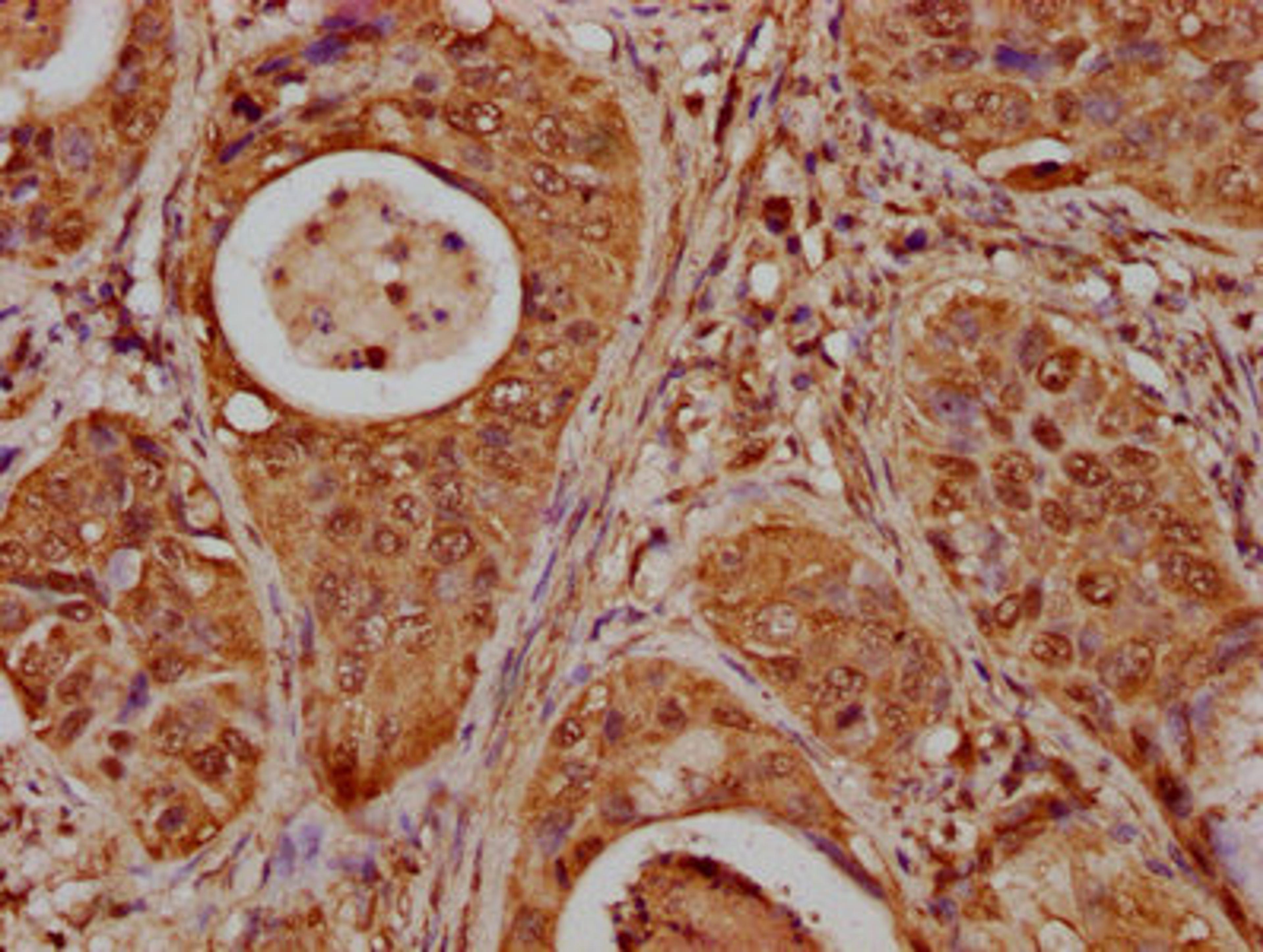 IHC image of CSB-PA010379OA85nbhbHU diluted at 1:20 and staining in paraffin-embedded human cervical cancer performed on a Leica BondTM system. After dewaxing and hydration, antigen retrieval was mediated by high pressure in a citrate buffer (pH 6.0). Section was blocked with 10% normal goat serum 30min at RT. Then primary antibody (1% BSA) was incubated at 4°C overnight. The primary is detected by a biotinylated secondary antibody and visualized using an HRP conjugated SP system.