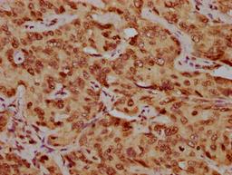 IHC image of CSB-PA010378OA210nhibHU diluted at 1:20 and staining in paraffin-embedded human liver cancer performed on a Leica BondTM system. After dewaxing and hydration, antigen retrieval was mediated by high pressure in a citrate buffer (pH 6.0). Section was blocked with 10% normal goat serum 30min at RT. Then primary antibody (1% BSA) was incubated at 4&deg;C overnight. The primary is detected by a biotinylated secondary antibody and visualized using an HRP conjugated SP system.