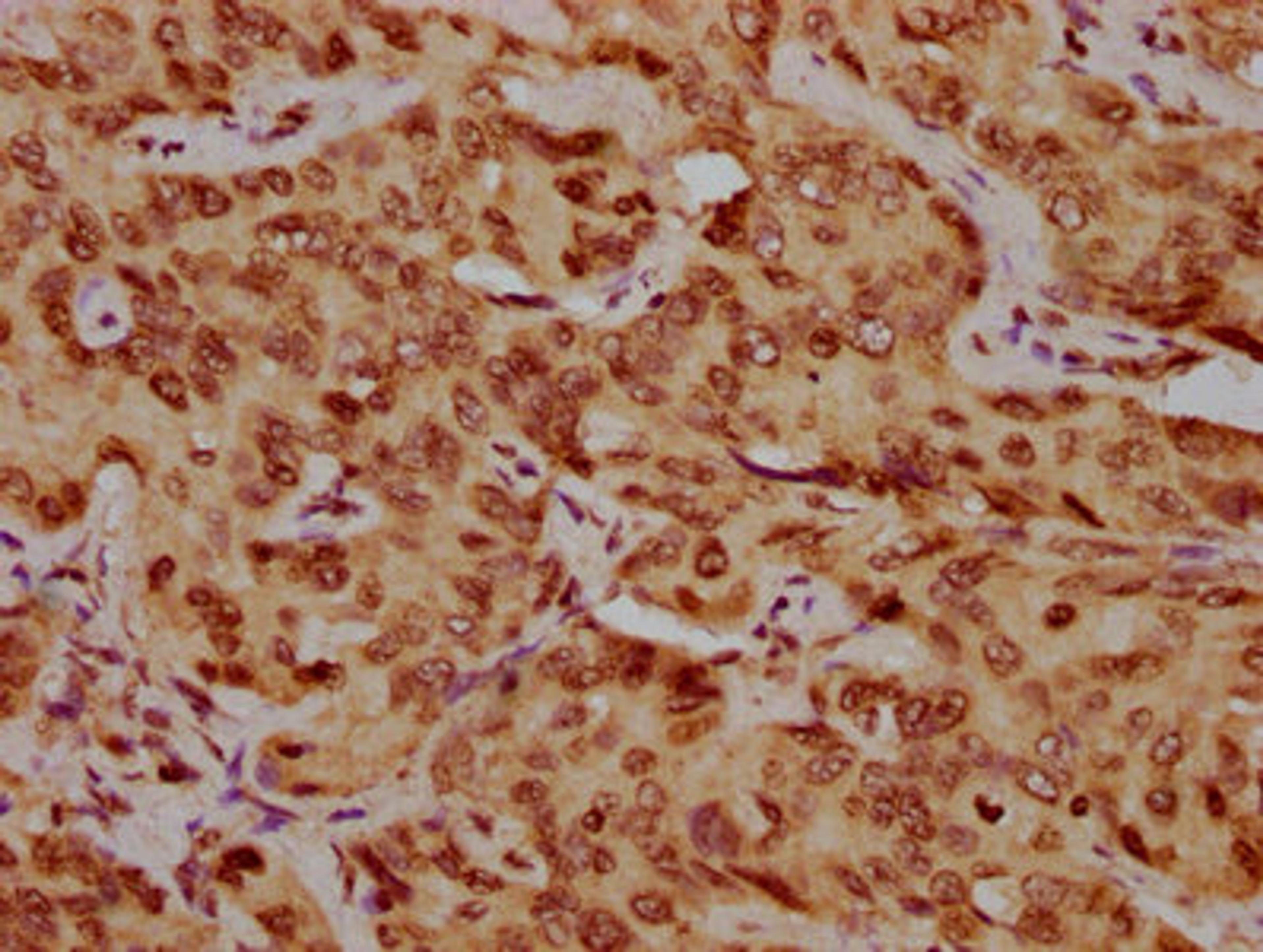 IHC image of CSB-PA010378OA210nhibHU diluted at 1:20 and staining in paraffin-embedded human liver cancer performed on a Leica BondTM system. After dewaxing and hydration, antigen retrieval was mediated by high pressure in a citrate buffer (pH 6.0). Section was blocked with 10% normal goat serum 30min at RT. Then primary antibody (1% BSA) was incubated at 4&deg;C overnight. The primary is detected by a biotinylated secondary antibody and visualized using an HRP conjugated SP system.