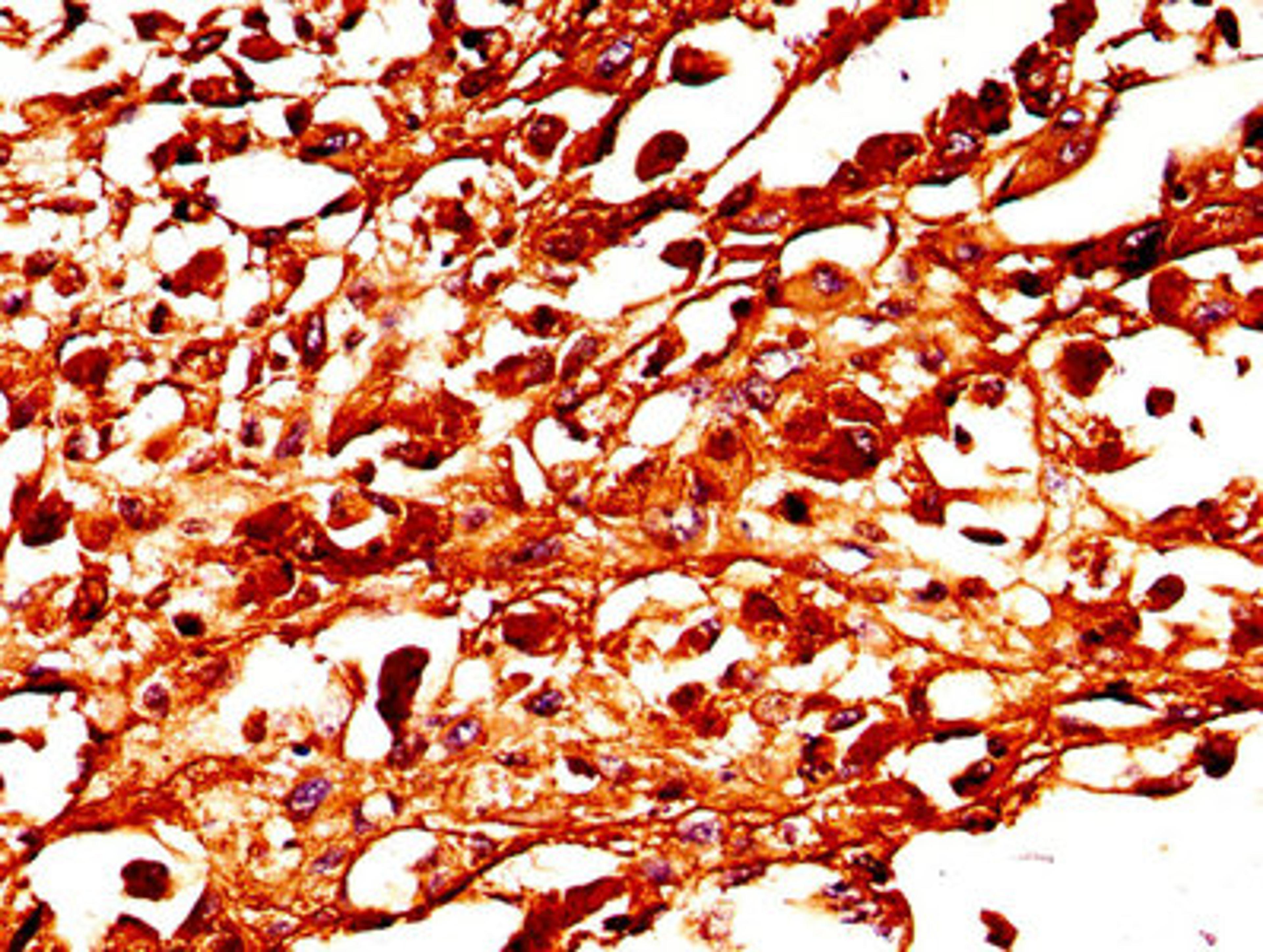 IHC image of CSB-PA025394LA01HU diluted at 1:300 and staining in paraffin-embedded human melanoma performed on a Leica BondTM system. After dewaxing and hydration, antigen retrieval was mediated by high pressure in a citrate buffer (pH 6.0). Section was blocked with 10% normal goat serum 30min at RT. Then primary antibody (1% BSA) was incubated at 4&deg;C overnight. The primary is detected by a biotinylated secondary antibody and visualized using an HRP conjugated SP system.