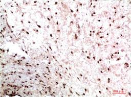 Immunohistochemical analysis of paraffin-embedded Human Colon Carcinoma Tissue using HP-1γ  Mouse mAb diluted at 1:200.
