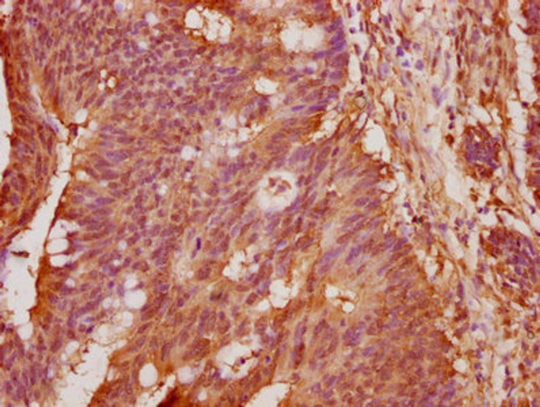 IHC image of CSB-PA874794LA01HU diluted at 1:100 and staining in paraffin-embedded human colon cancer performed on a Leica BondTM system. After dewaxing and hydration, antigen retrieval was mediated by high pressure in a citrate buffer (pH 6.0). Section was blocked with 10% normal goat serum 30min at RT. Then primary antibody (1% BSA) was incubated at 4°C overnight. The primary is detected by a biotinylated secondary antibody and visualized using an HRP conjugated SP system.