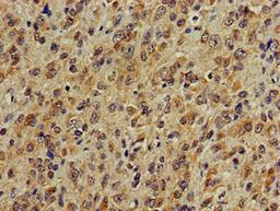 Immunohistochemistry of paraffin-embedded human glioma using CSB-PA865102LA01HU at dilution of 1:100