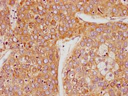 IHC image of CSB-PA27499A0Rb diluted at 1:100 and staining in paraffin-embedded human liver cancer performed on a Leica BondTM system. After dewaxing and hydration, antigen retrieval was mediated by high pressure in a citrate buffer (pH 6.0). Section was blocked with 10% normal goat serum 30min at RT. Then primary antibody (1% BSA) was incubated at 4°C overnight. The primary is detected by a biotinylated secondary antibody and visualized using an HRP conjugated SP system.