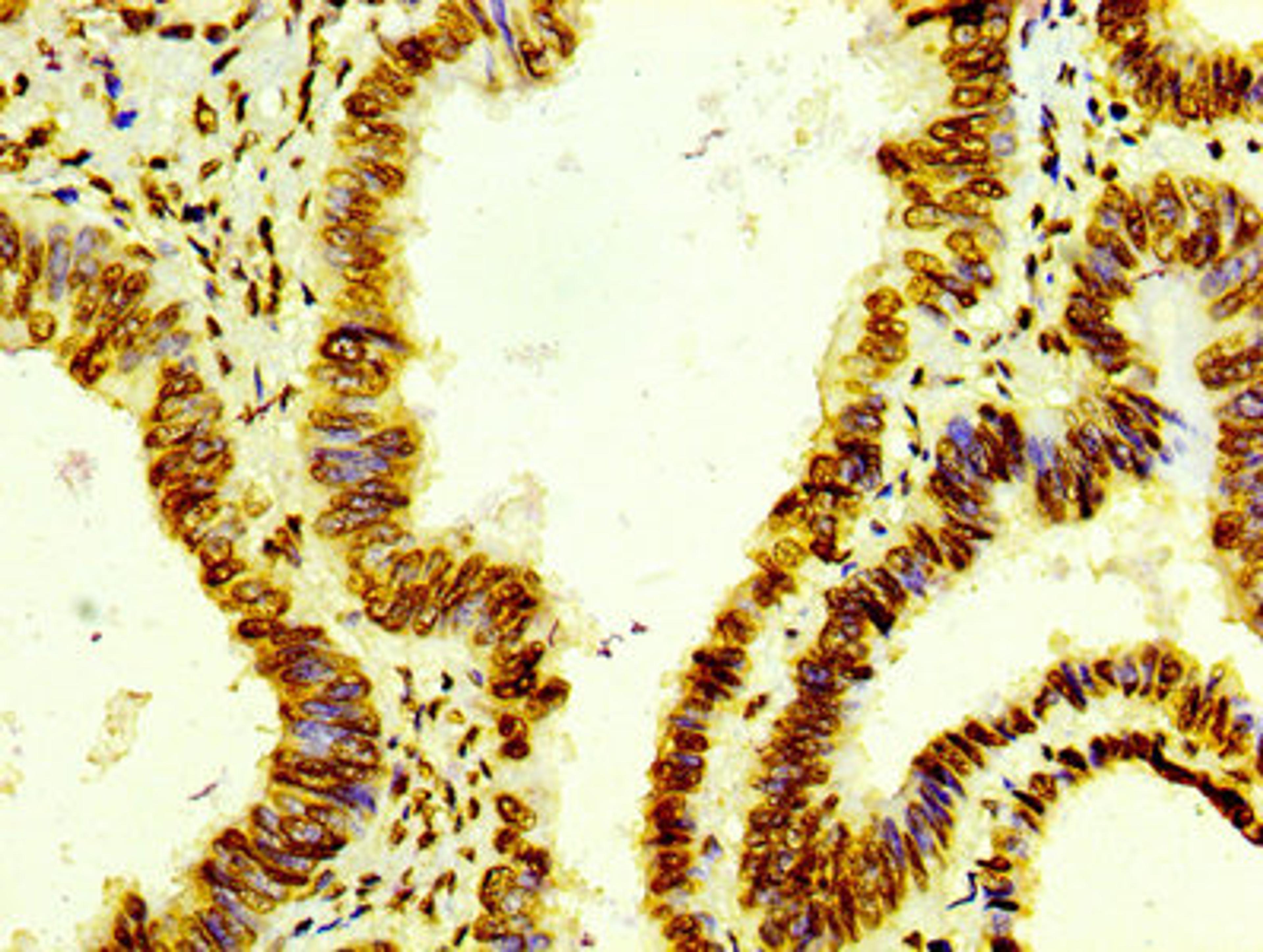 IHC image of CSB-RA010429A0HU diluted at 1:100 and staining in paraffin-embedded human colon cancer performed on a Leica BondTM system. After dewaxing and hydration, antigen retrieval was mediated by high pressure in a citrate buffer (pH 6.0). Section was blocked with 10% normal goat serum 30min at RT. Then primary antibody (1% BSA) was incubated at 4℃ overnight. The primary is detected by a biotinylated secondary antibody and visualized using an HRP conjugated SP system.