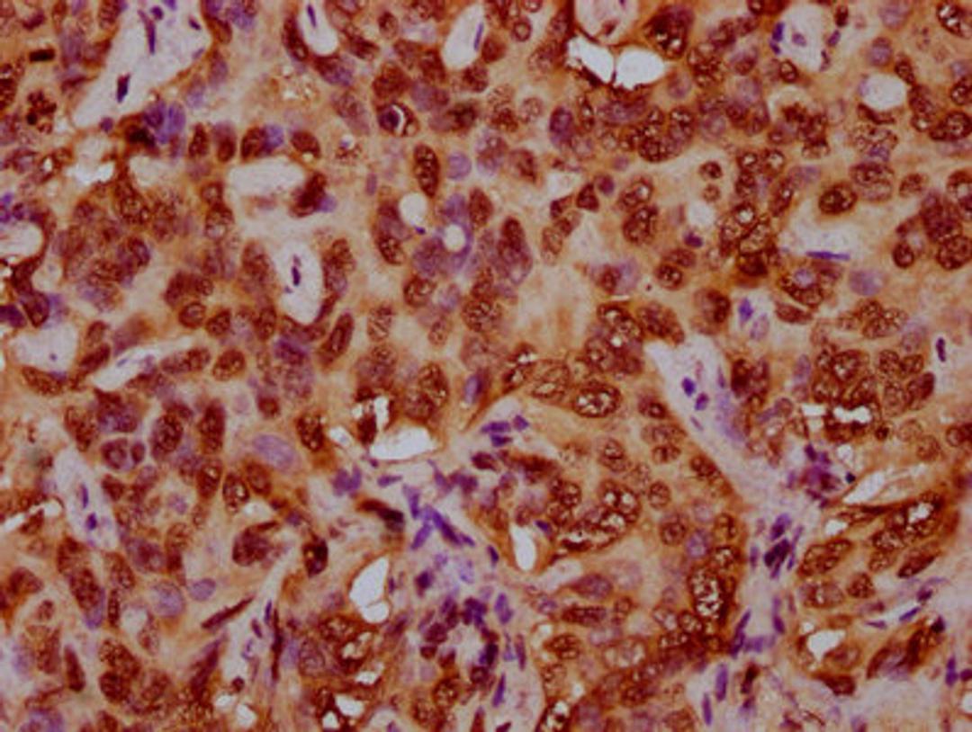 IHC image of CSB-PA010429OA79nforHU diluted at 1:5 and staining in paraffin-embedded human liver cancer performed on a Leica BondTM system. After dewaxing and hydration, antigen retrieval was mediated by high pressure in a citrate buffer (pH 6.0). Section was blocked with 10% normal goat serum 30min at RT. Then primary antibody (1% BSA) was incubated at 4&deg;C overnight. The primary is detected by a biotinylated secondary antibody and visualized using an HRP conjugated SP system.
