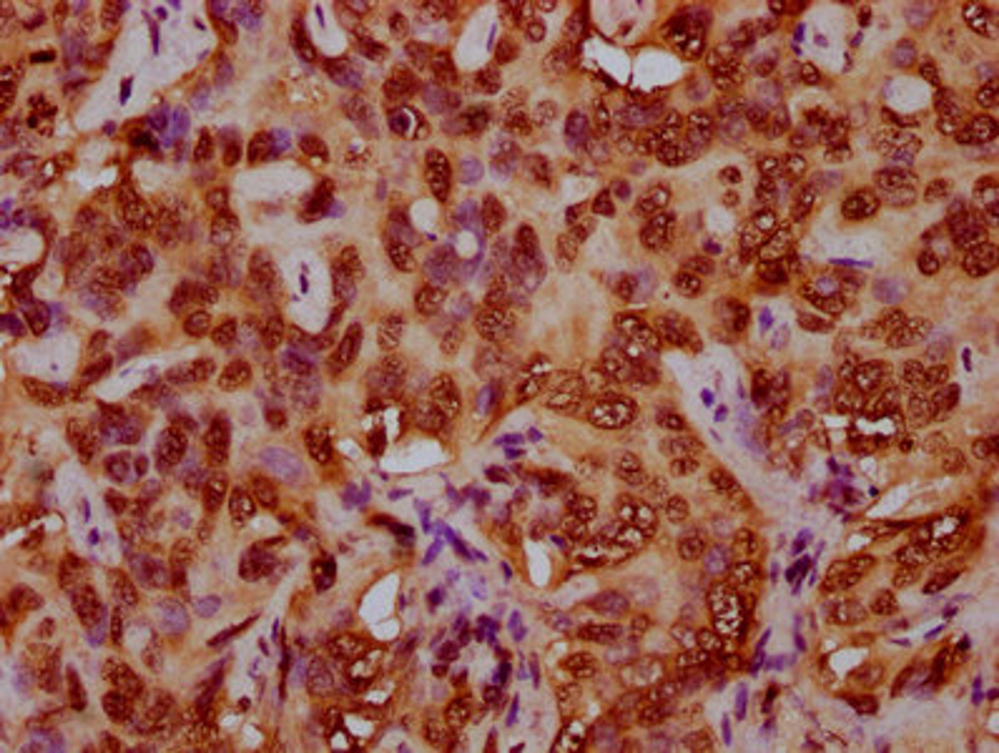 IHC image of CSB-PA010429OA79nforHU diluted at 1:5 and staining in paraffin-embedded human liver cancer performed on a Leica BondTM system. After dewaxing and hydration, antigen retrieval was mediated by high pressure in a citrate buffer (pH 6.0). Section was blocked with 10% normal goat serum 30min at RT. Then primary antibody (1% BSA) was incubated at 4°C overnight. The primary is detected by a biotinylated secondary antibody and visualized using an HRP conjugated SP system.