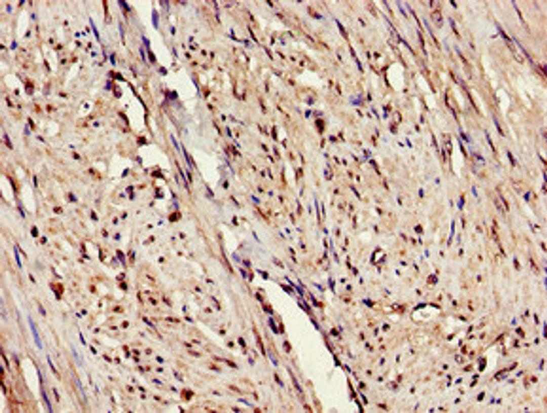 Immunohistochemistry of paraffin-embedded human endometrial cancer using CSB-PA007760LA01HU at dilution of 1:100