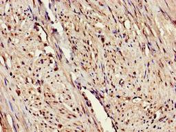 Immunohistochemistry of paraffin-embedded human endometrial cancer using CSB-PA007760LA01HU at dilution of 1:100